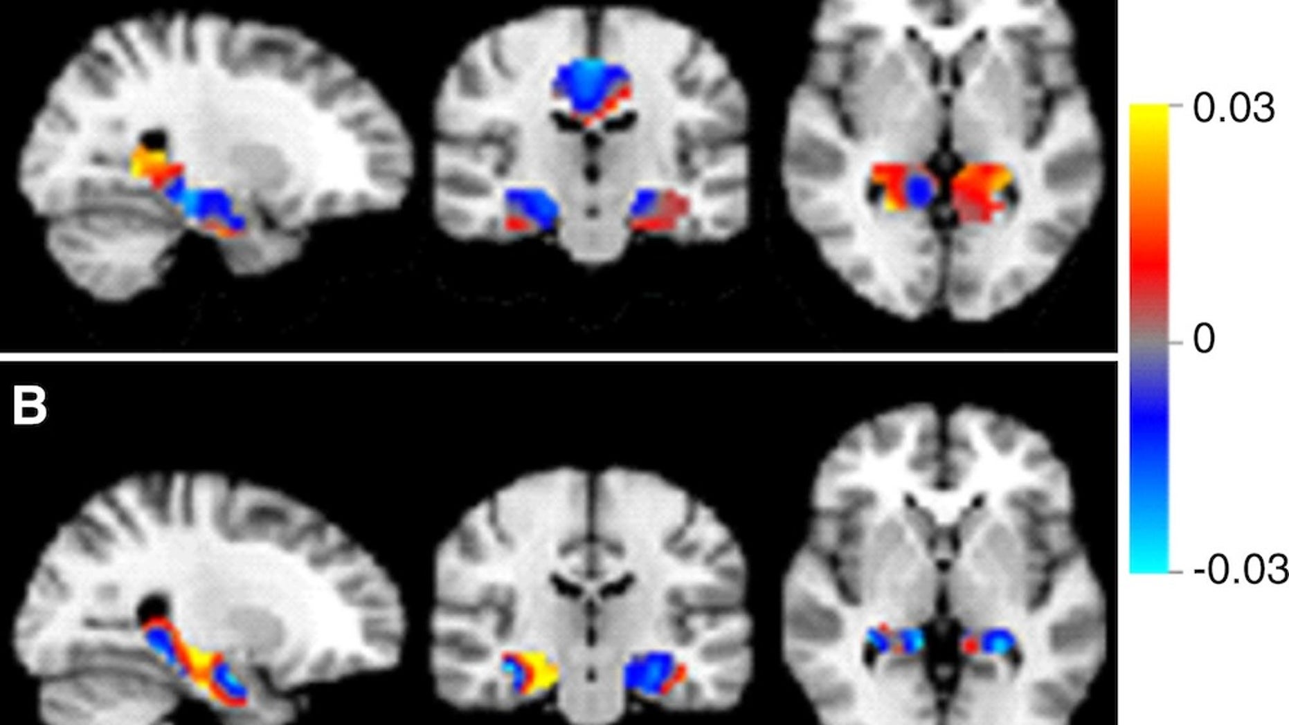 Discrimination maps for classifying mild cognitive impairment (MCI) subgroups, inside the masks that resulted in the highest accuracies. A: between patients with MCI that converted to Alzheimer's disease (MCIc) and s
