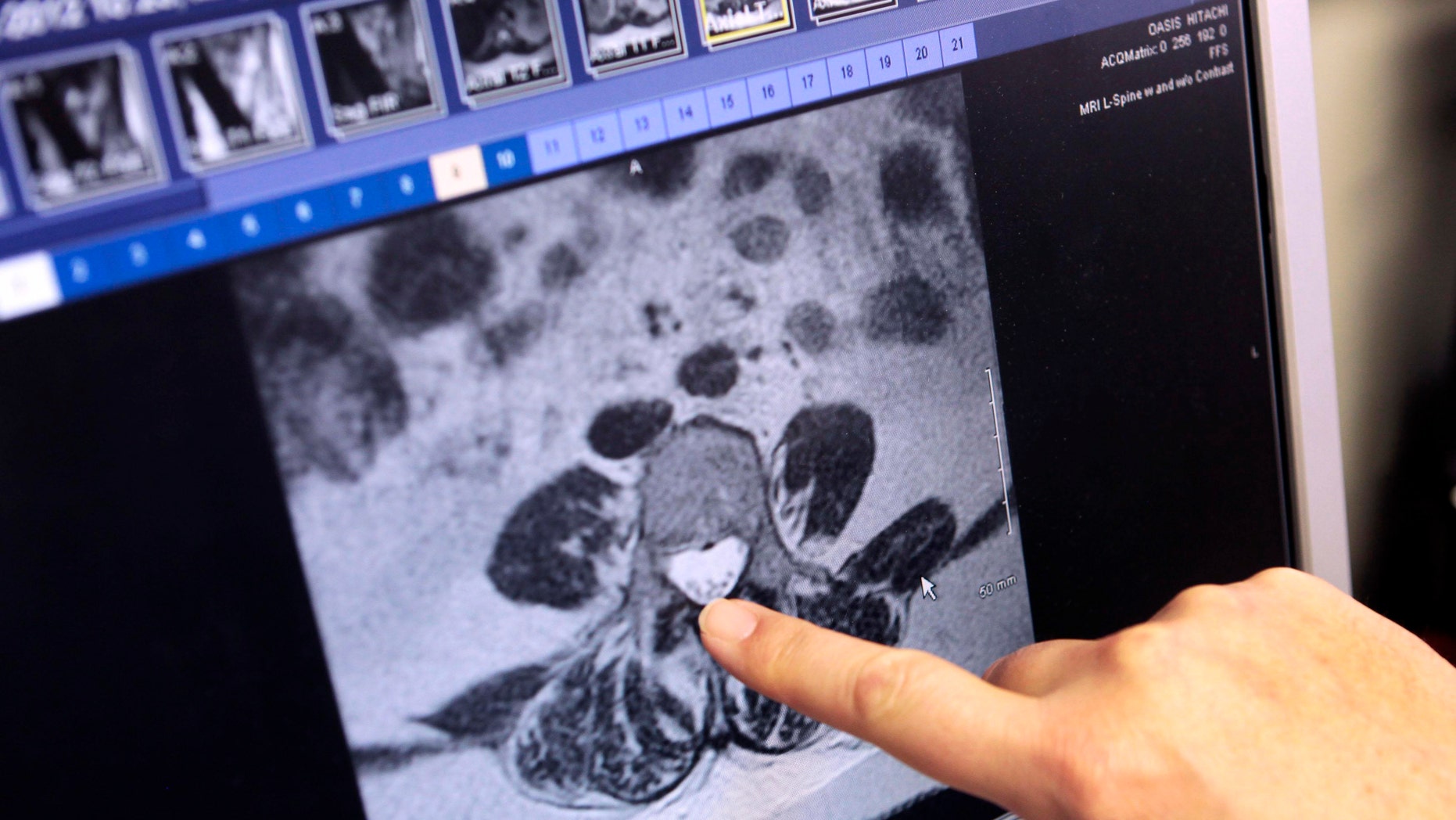 A doctor shows a digital slide of a patients MRI, showing the infected area of the spine in a meningitis case. (REUTERS/Rebecca Cook)
