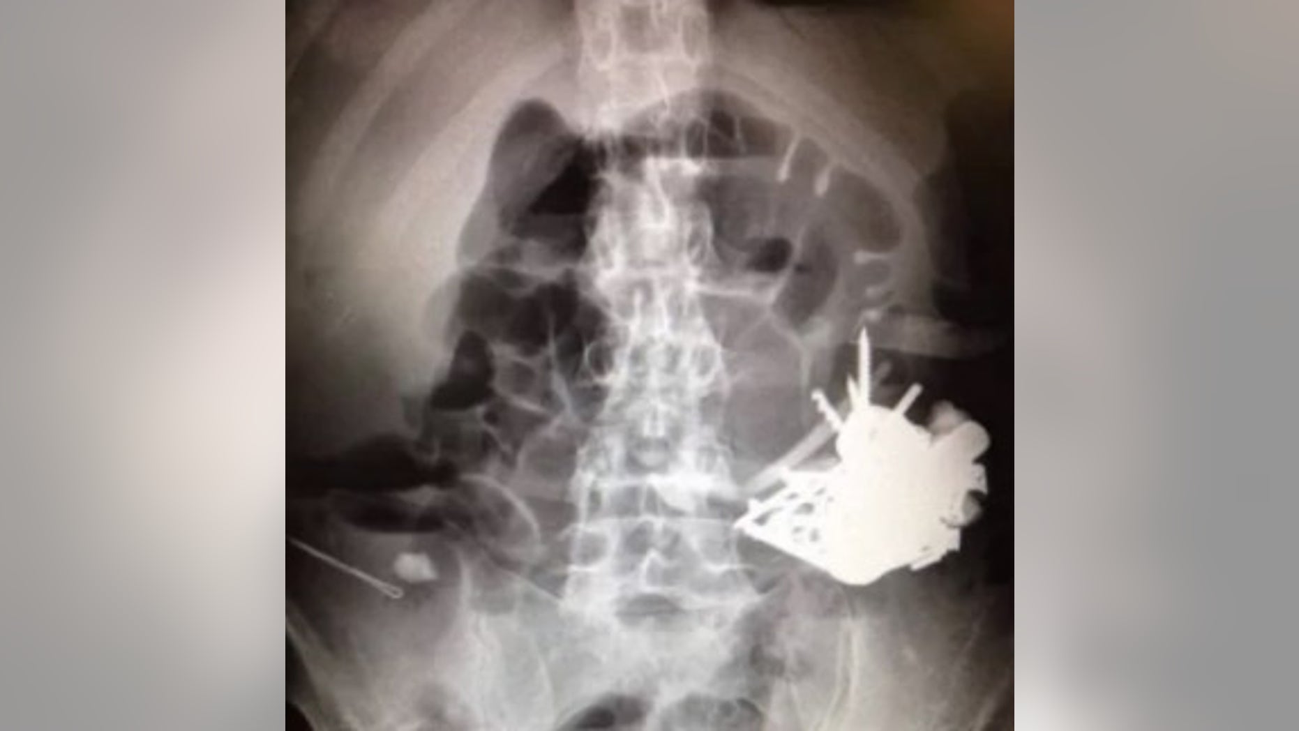 Despite receiving treatment for psychosis, the 52-year-old could not stop intentionally swallowing metal items.