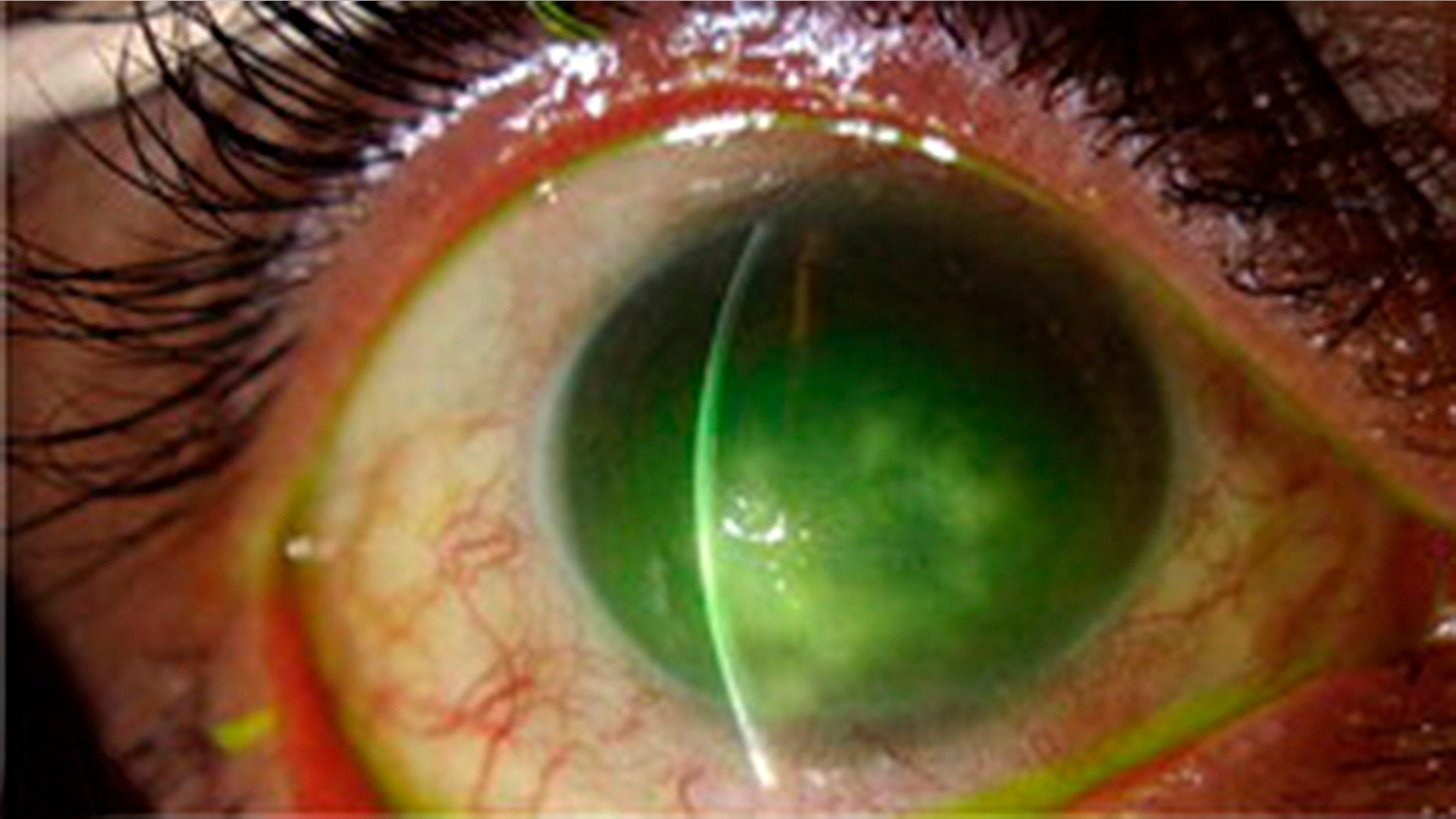 Microsporidial keratitis infected eye. (National Institute of Health)
