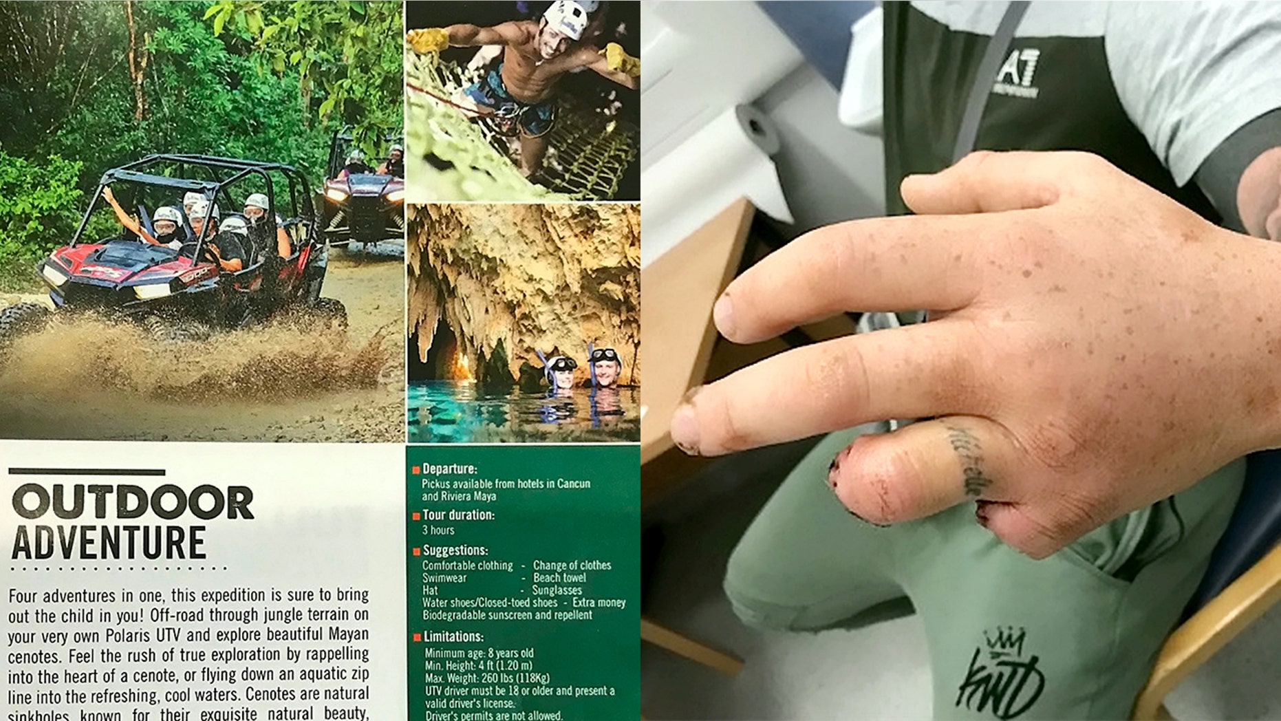A father's UTV crashed on a jungle excursion in Mexico, causing him to lose two fingers.
