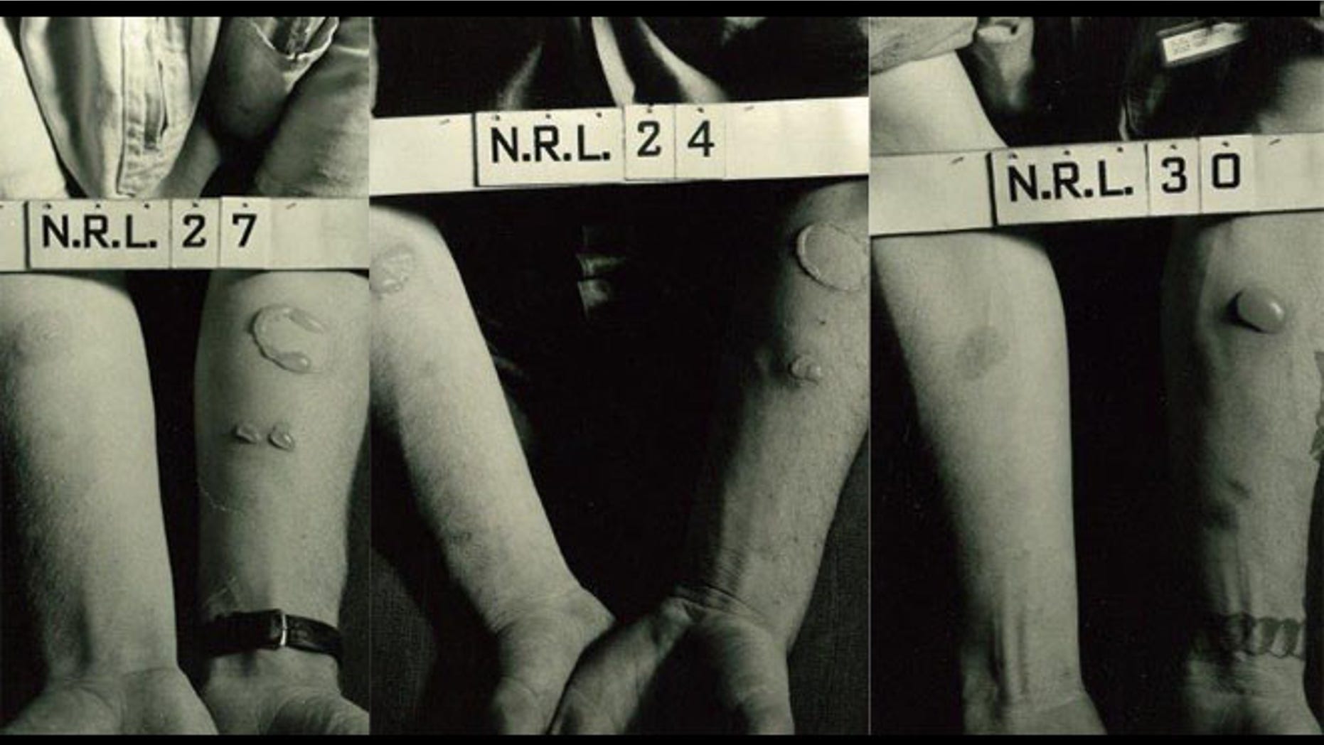 Images of the effects of mustard gas on soldiers' skin. (Photos: Naval Research Laboratory)