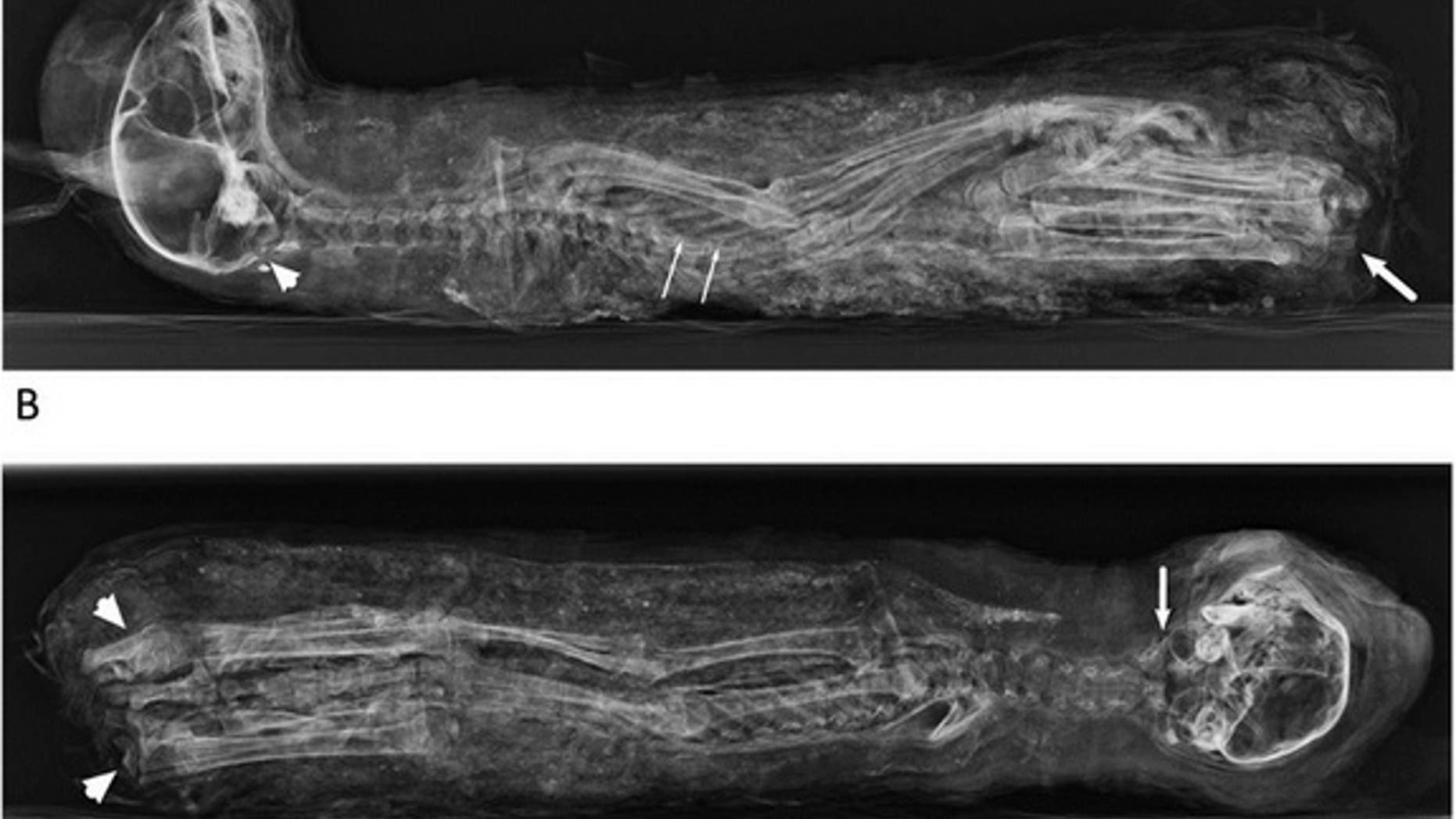 The cat mummy from the side (A) and front (B). In (A), the thin white arrows indicate the squeezed thorax; white arrow, fractured back bones of the tail; white arrowhead, fracture/hole in the occipital region of the skull.