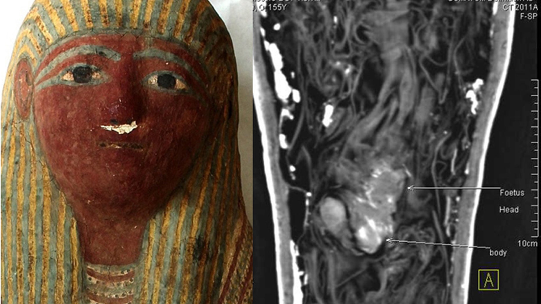 The mummy mask and the CT scan showing the fetus.