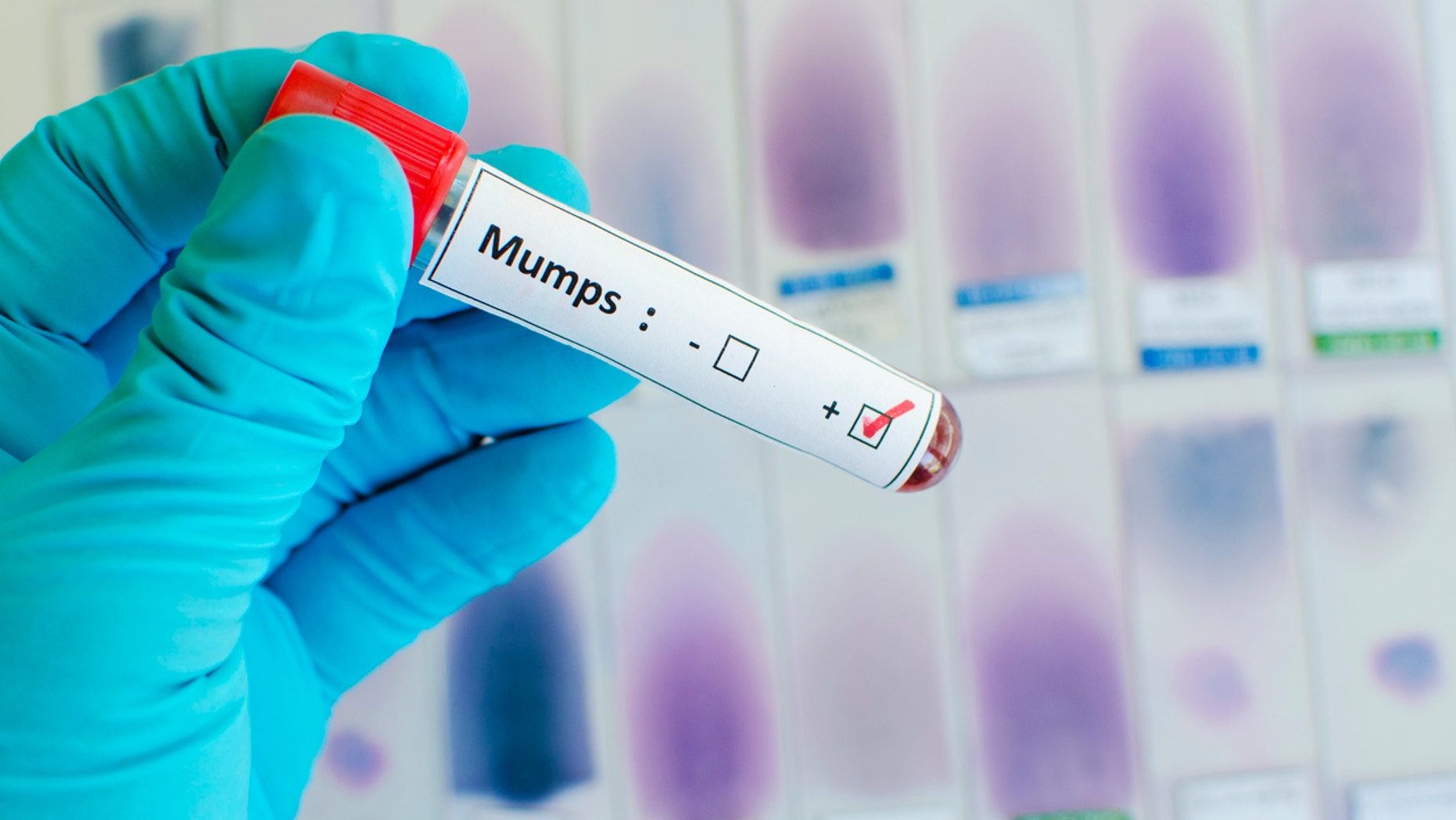 A statement said the school’s health providers are working with state officials to manage and test students with potential symptoms of the disease.