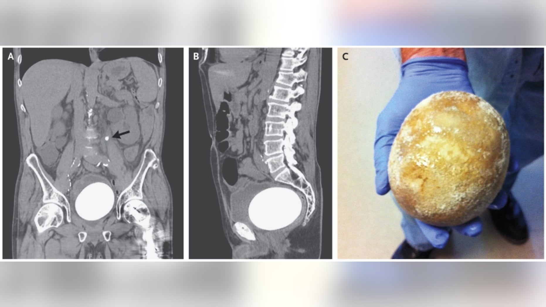 The panel on the left shows a scan of the man's abdomen. The middle panel shows the man's abdomen from the side, and the panel on the right shows the egg-shaped neobladder stone after it was surgically removed.