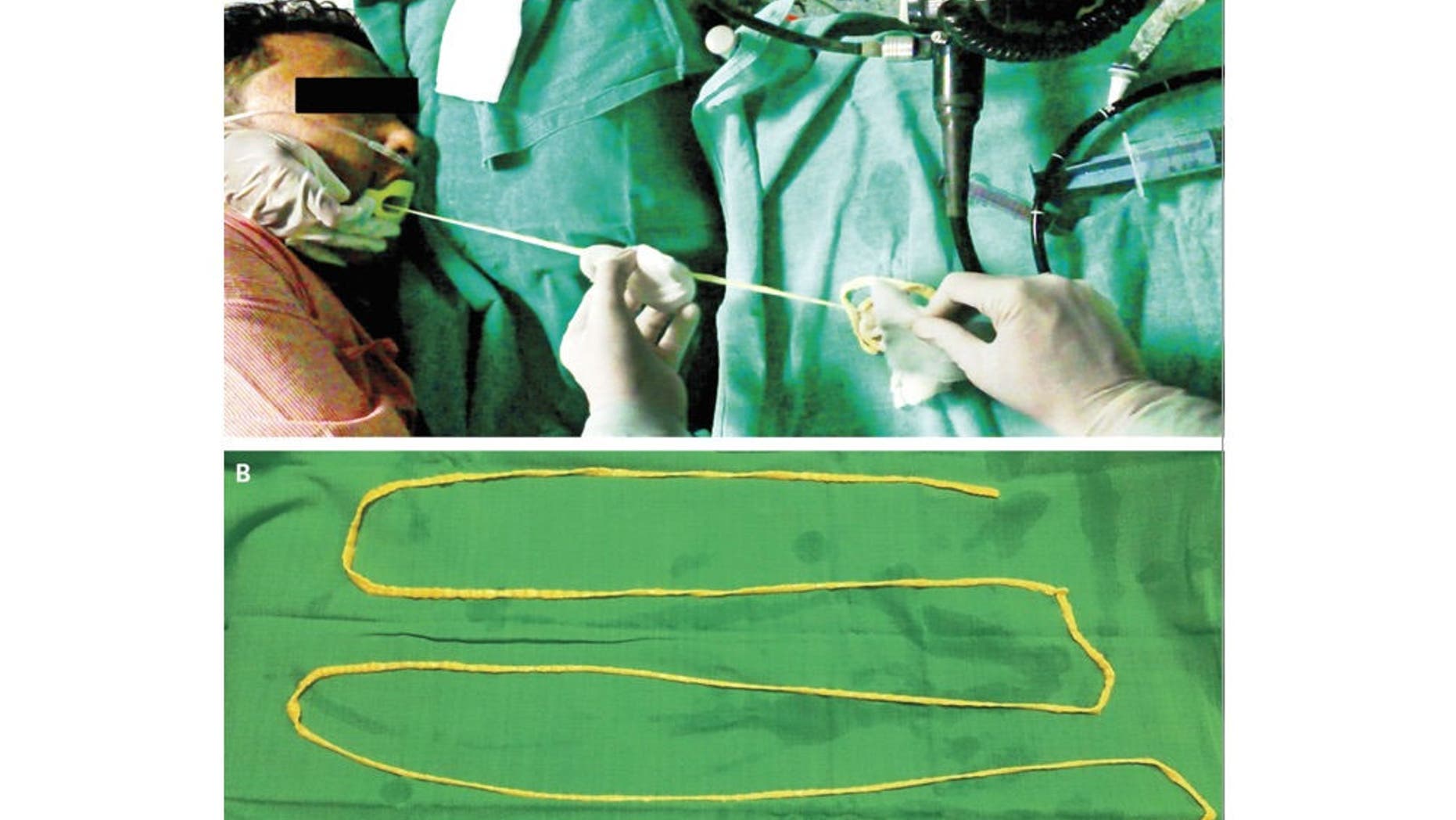 The image shows doctors removing the pork tapeworm from the patient’s mouth. The bottom image shows the intact tapeworm after it was removed from the man’s gut. The tapeworm was 1.88 meters (6.6 feet) long.