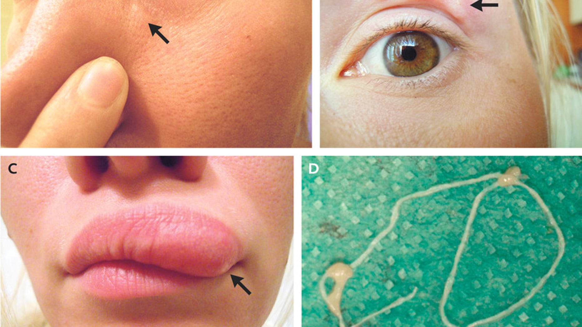 The woman, who had recently traveled outside of Moscow and endured numerous mosquito bites, documented the mysterious moving bumps with a series of selfies.