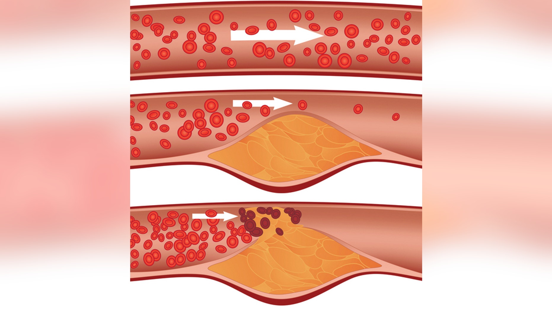 Cholesterol plaque in artery (atherosclerosis): Top artery is healthy. Middle & bottom arteries show plaque formation, rupturing, clotting & blood flow occlusion.