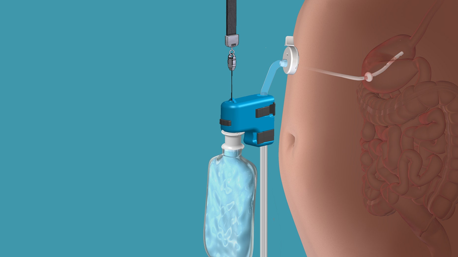 This rendering provided by Aspire Bariatrics, Inc. demonstrates the use of the AspireAssist weight loss device, approved by the Food and Drug Administration on Tuesday, June 14, 2016. The AspireAssist system consists of a thin tube implanted in the stomach, connecting to an outside port on the skin of the belly, which itself is connected to an external device, which helps remove nearly a third of the food stored in the stomach before calories are absorbed into the body, causing weight loss. (Aspire Bariatrics, Inc. via AP) MANDATORY CREDIT
