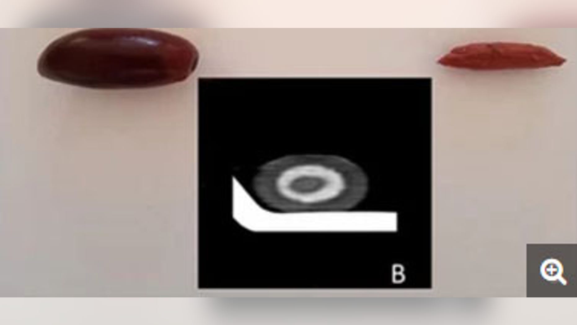 An olive and its pit; the inset image is a scan of a single black olive, which is similar in appearance to the olive in the man's gut.