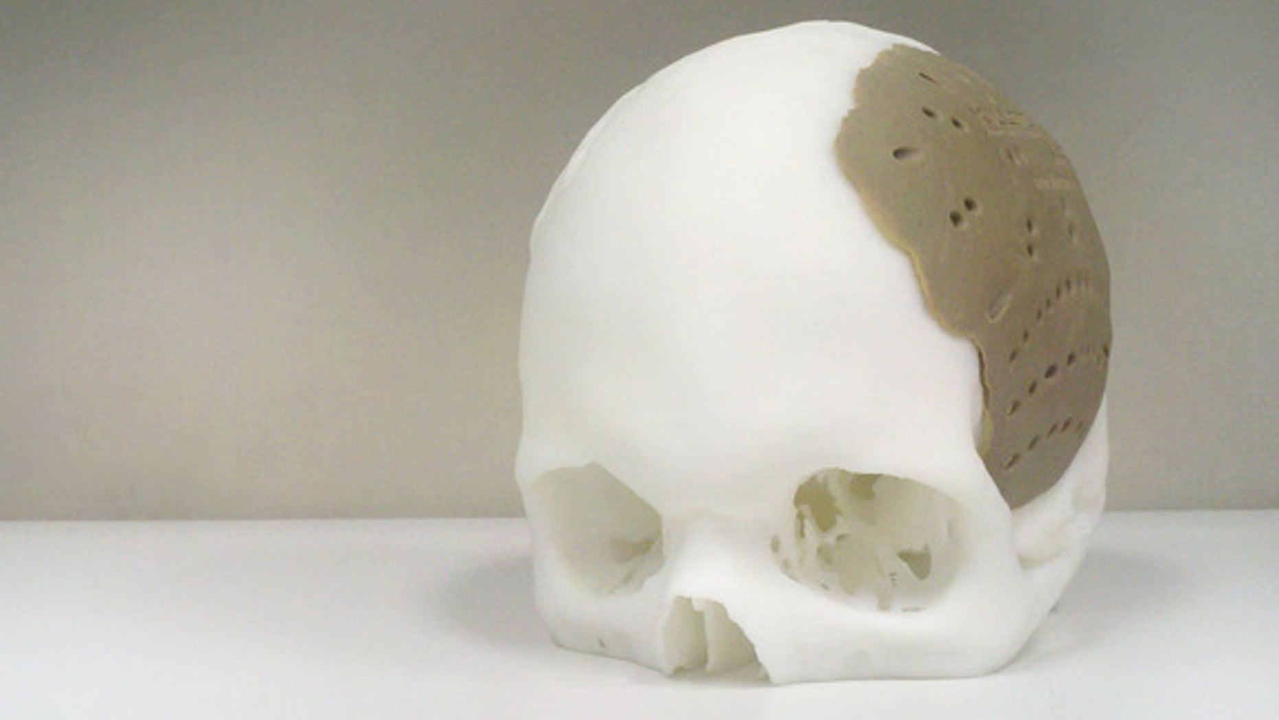 A 3D-printed skull implant.