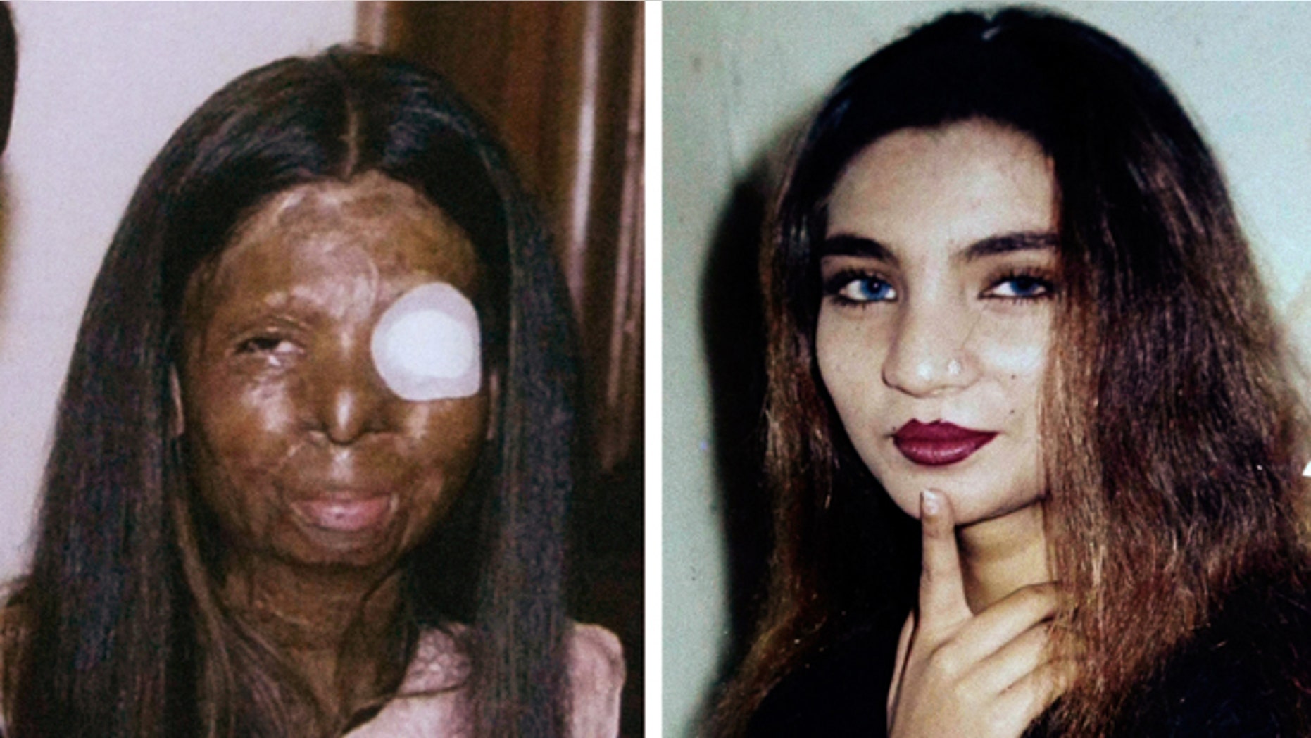 This combination of two undated photos provide by the family shows on the left, Fakhra Younus, some time after an acid attack twelve years ago, allegedly carried out by her then-husband, an ex-lawmaker and son of a political powerhouse; and on the right, Younus sometime before the attack. Younus, who had endured more than three dozen surgeries over more than a decade to repair her severely damaged face and body, finally decided life was no longer worth living.