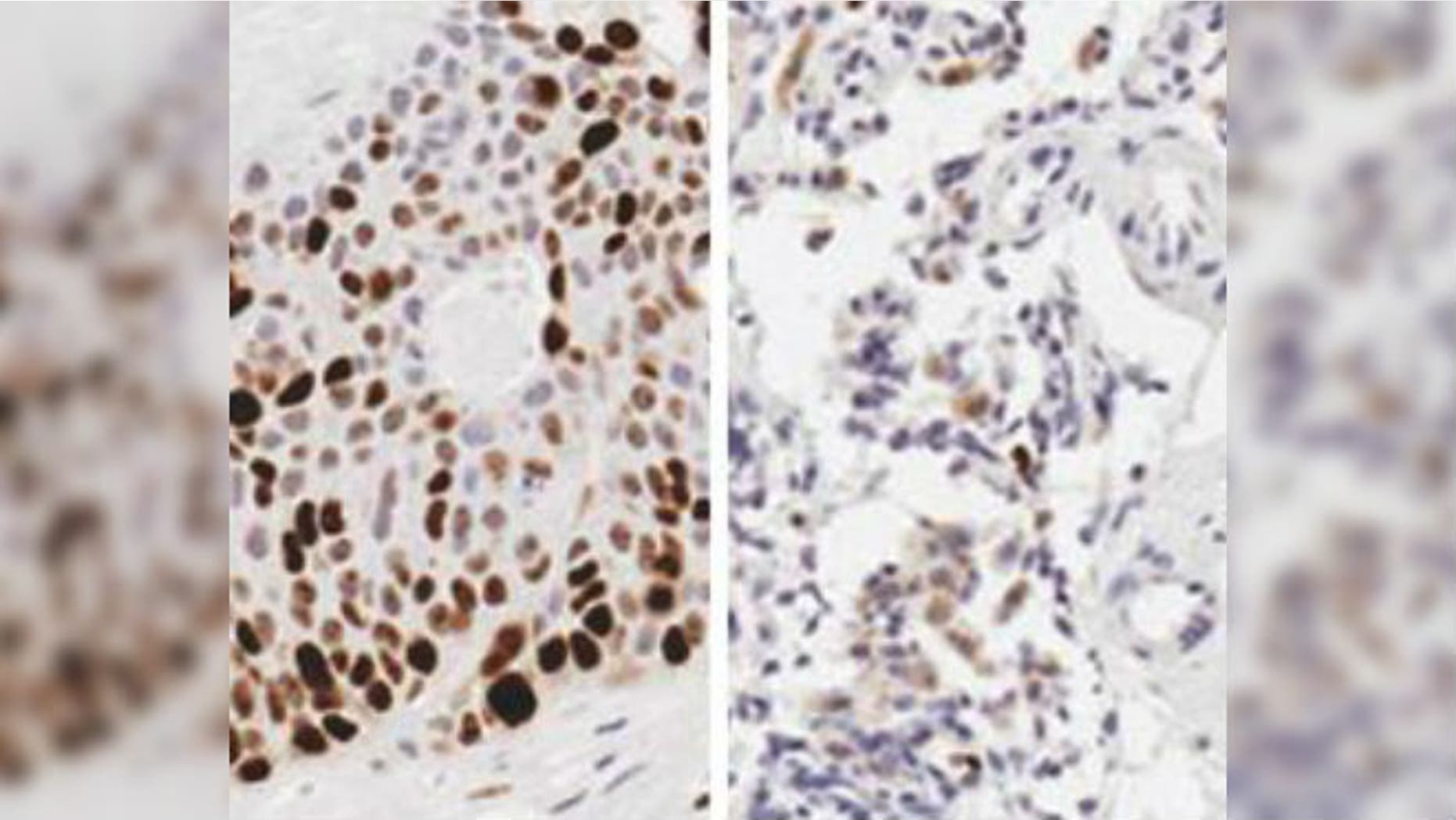 Compared to a control (left), mice treated with a chemotherapy drug using the device experienced significant growth reduction as confirmed by the lack of brown staining for a marker of tumor growth. Photo Credit: University of North Carolina at Chapel Hill