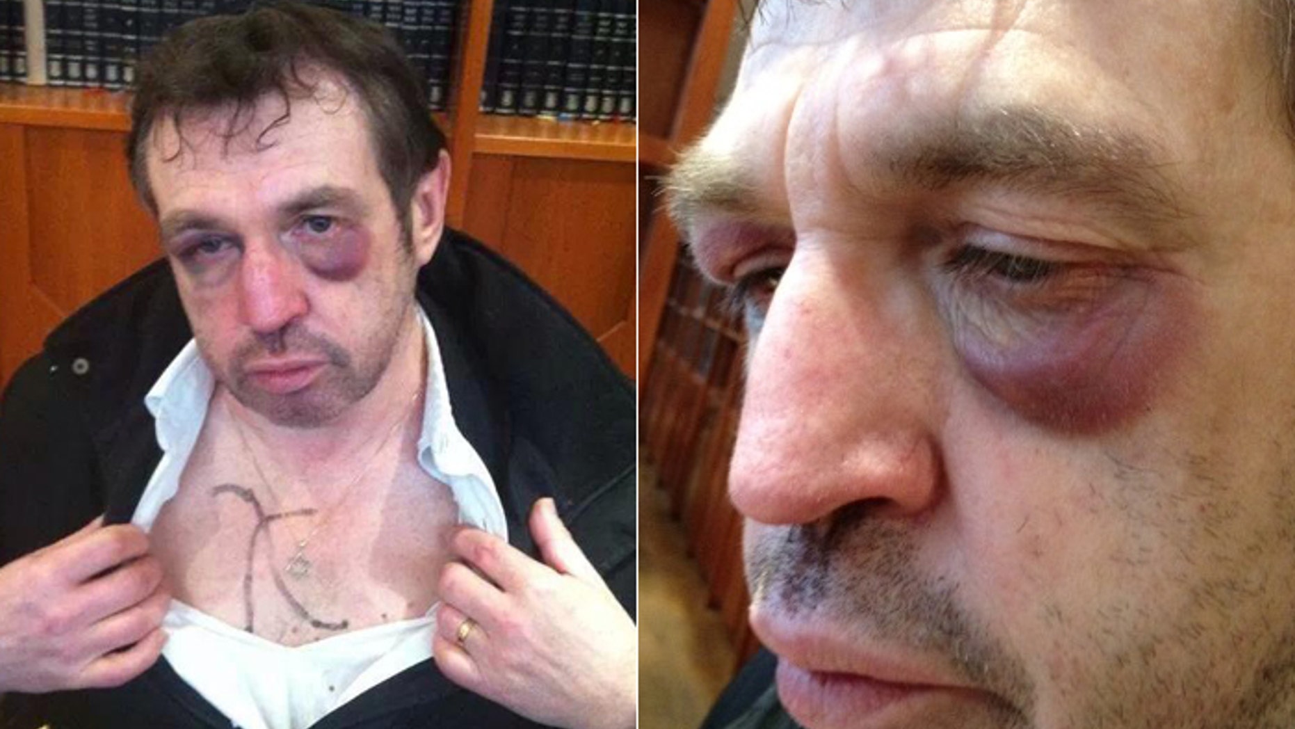 The 59-year-old man, identified only as "David," said he was leaving a kosher restaurant in Paris when three men beat him savagely. (The Algemeiner)