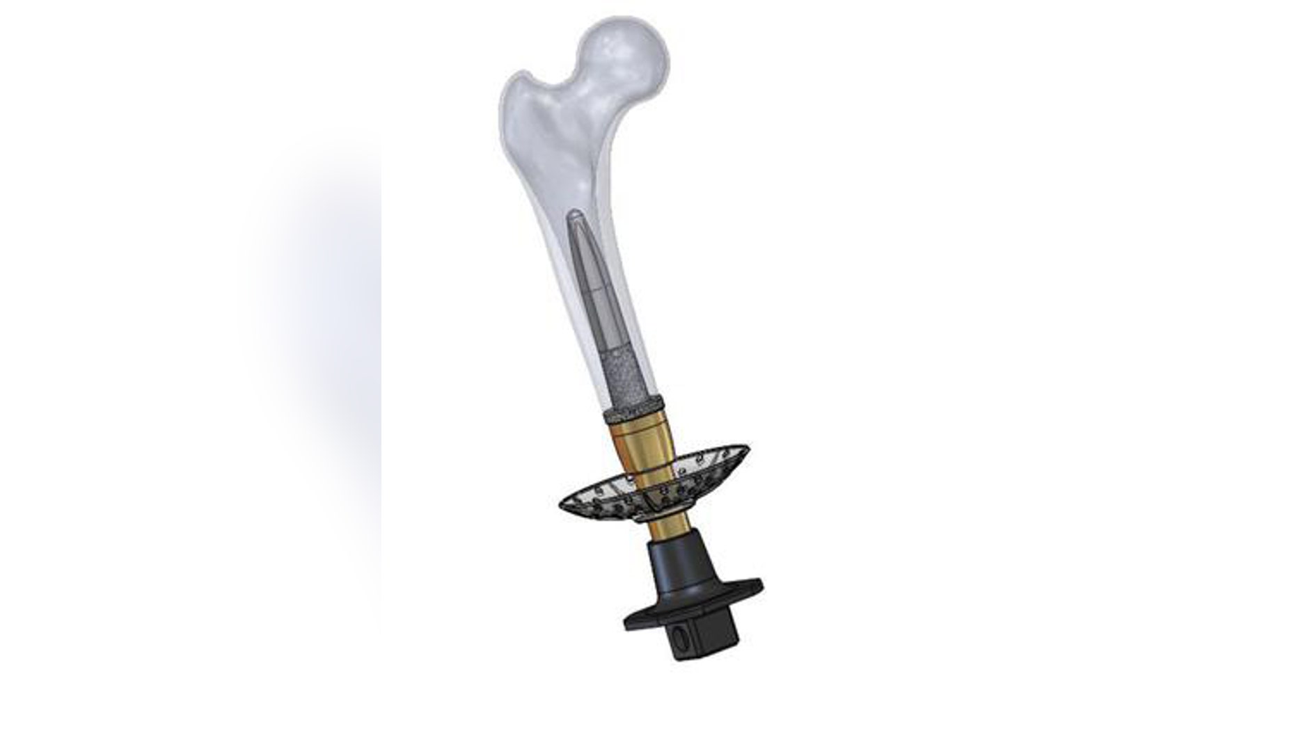 Percutaneous Osseointegrated Prosthesis (POP) assembly with bone.