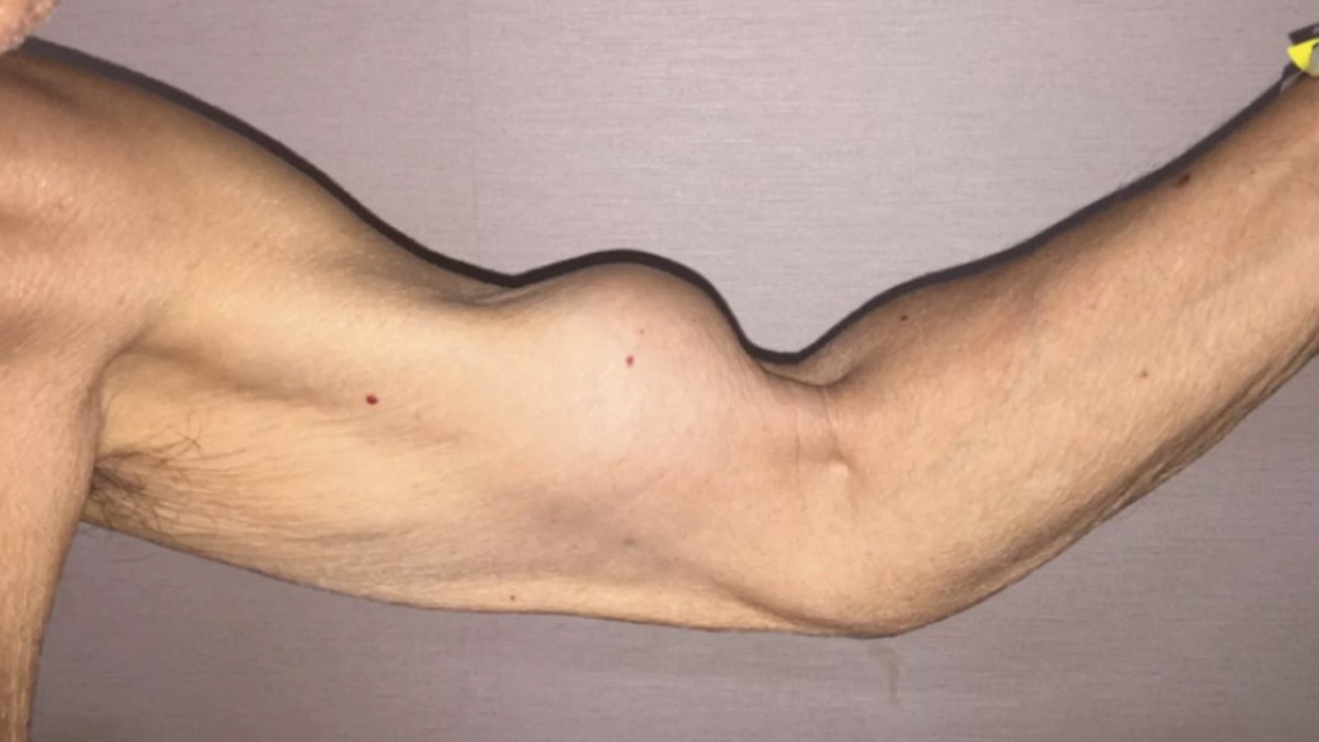 The 79-year-old's injury happened after he lifted an object and immediately felt a sharp pain in his left shoulder,