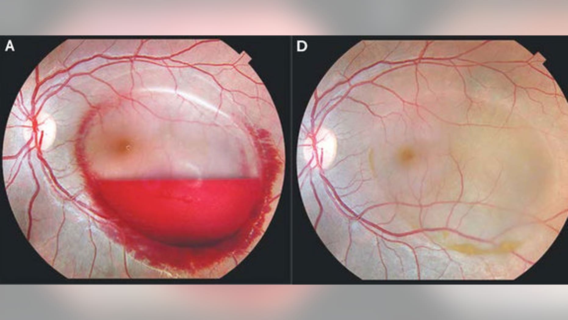 Forceful vomiting resulting from morning sickness caused a woman to burst a blood vessel in her left eye. Above, an image of the eye hemorrhage before and after it healed.