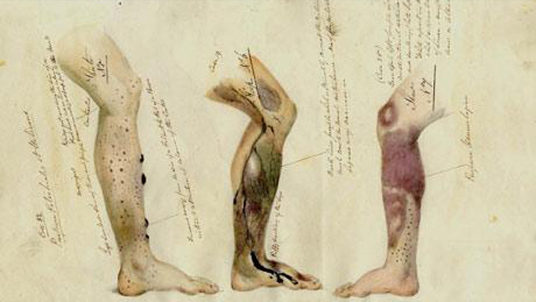 A drawing taken from journals written by Royal Navy surgeons between 1793 and 1880.