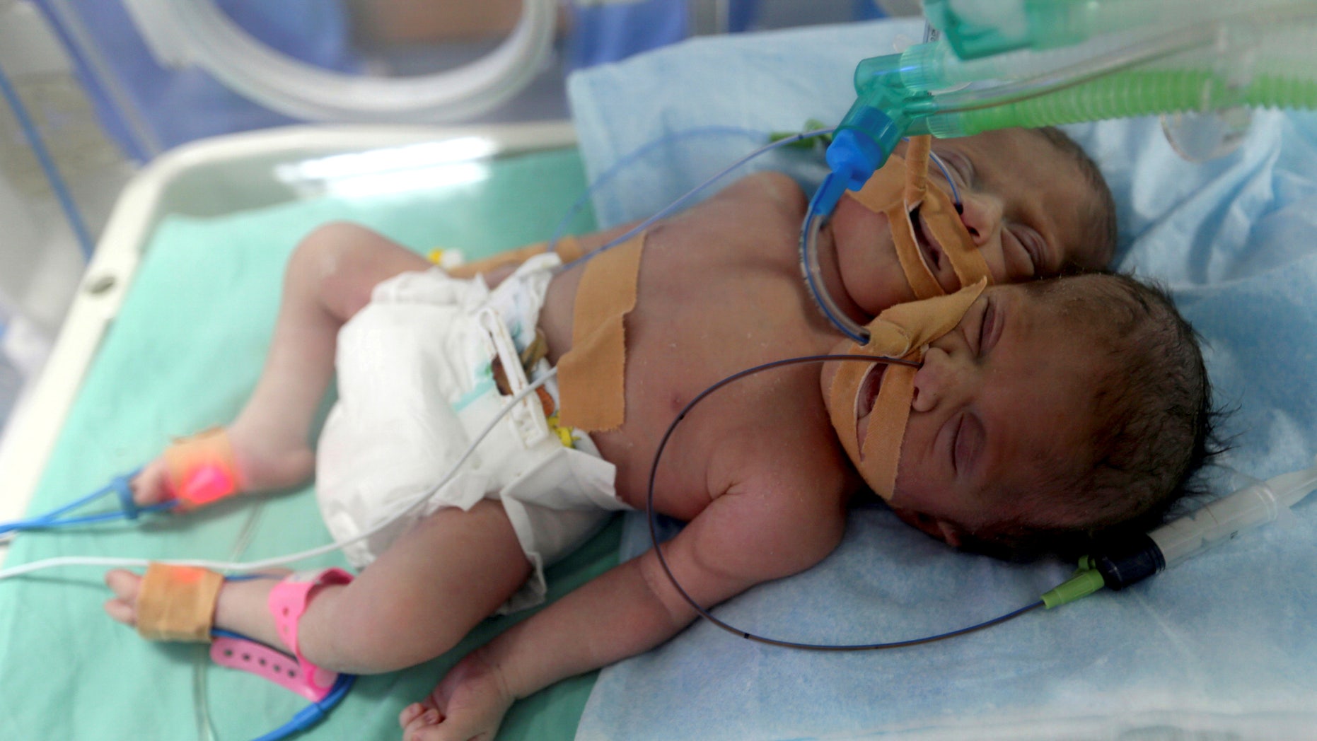 Palestinian conjoined twins lie in an incubator a day after they were born at Shifa hospital in Gaza City November 23, 2016.