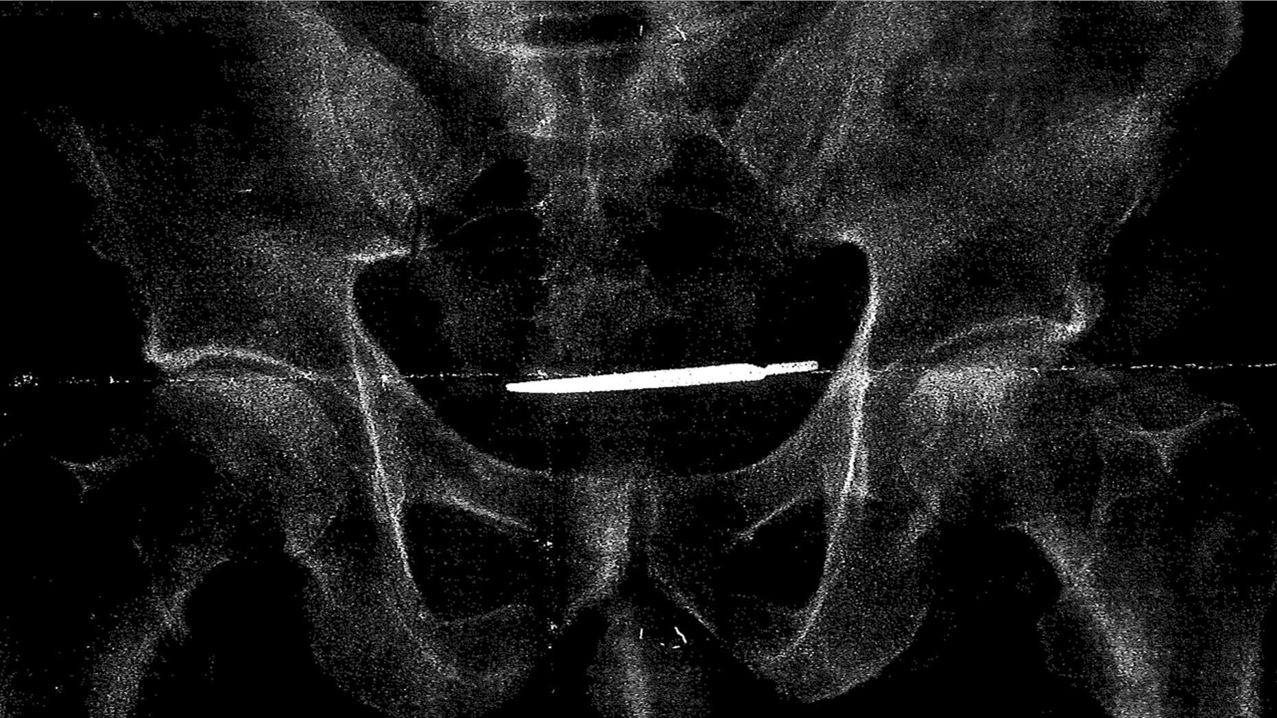 This X-ray image provided by the attorney for Glenford Turner, of Bridgeport, Ct., shows a scalpel that Turner claims was left inside him after undergoing surgery in 2013 at a Veterans Administration hospital in Connecticut.
