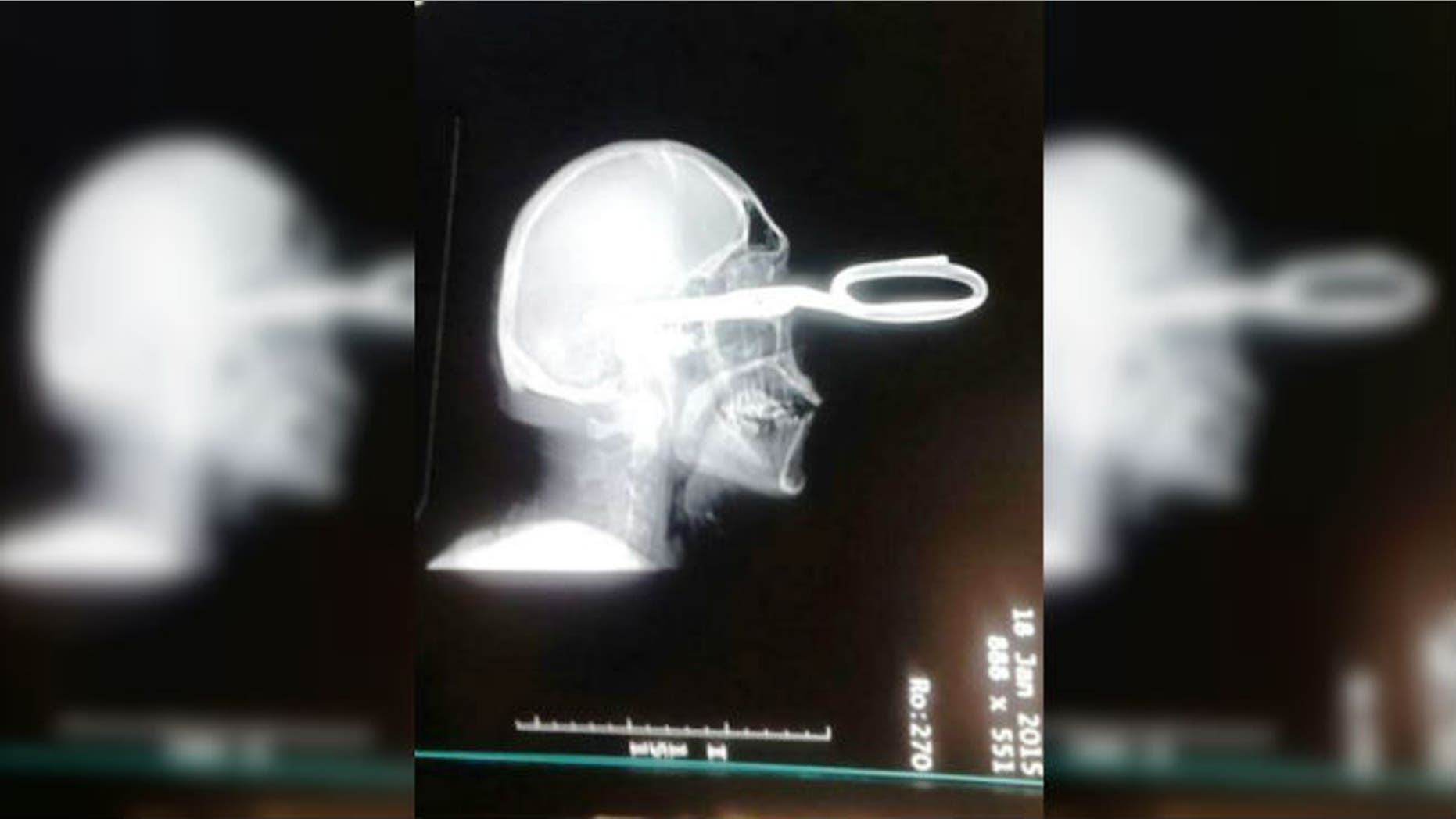 Man survives being stabbed in head with scissors | Fox News