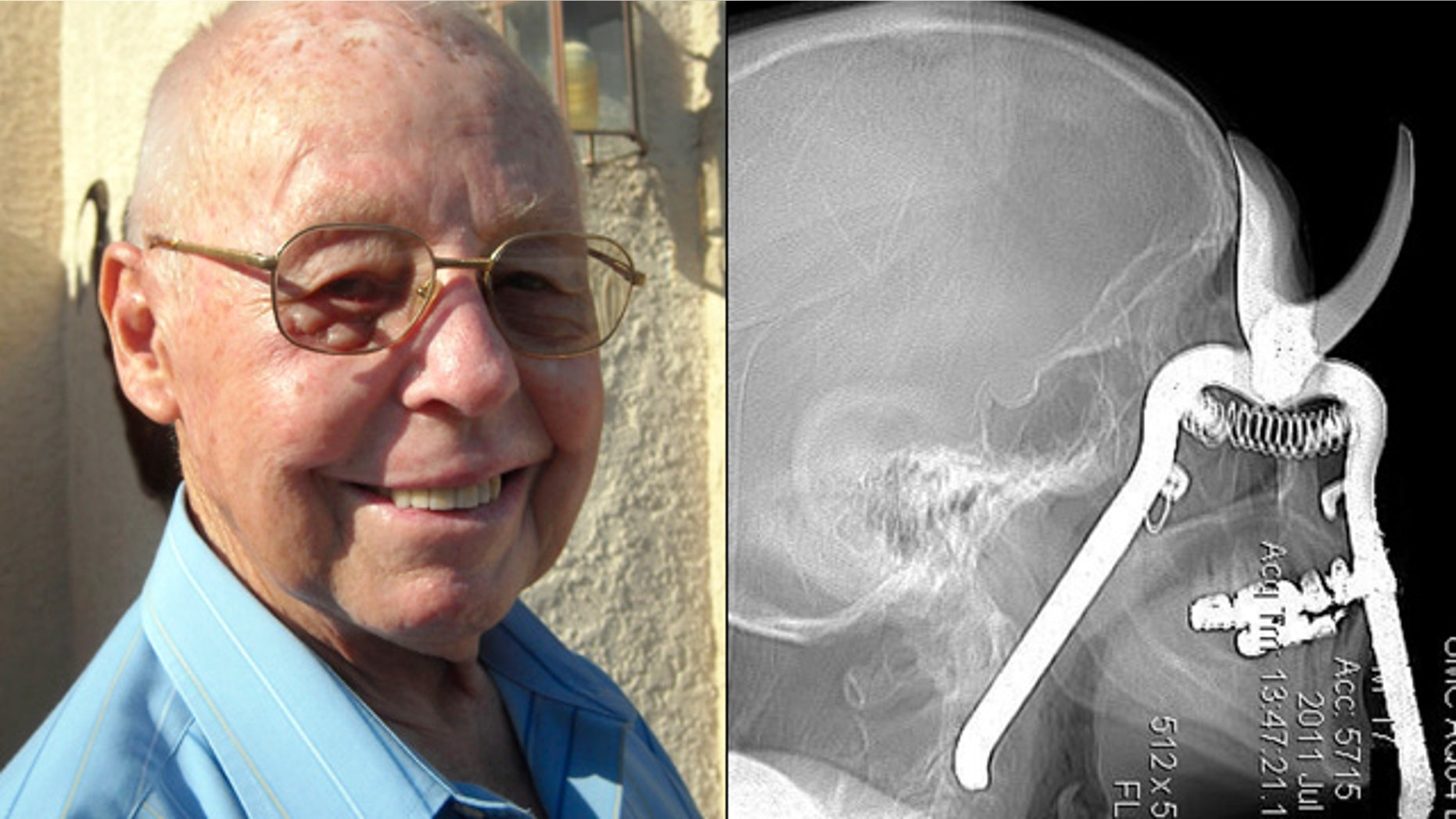 From left, Leroy Luetscher is seen a month after pruning shears pierced through his eye socket.