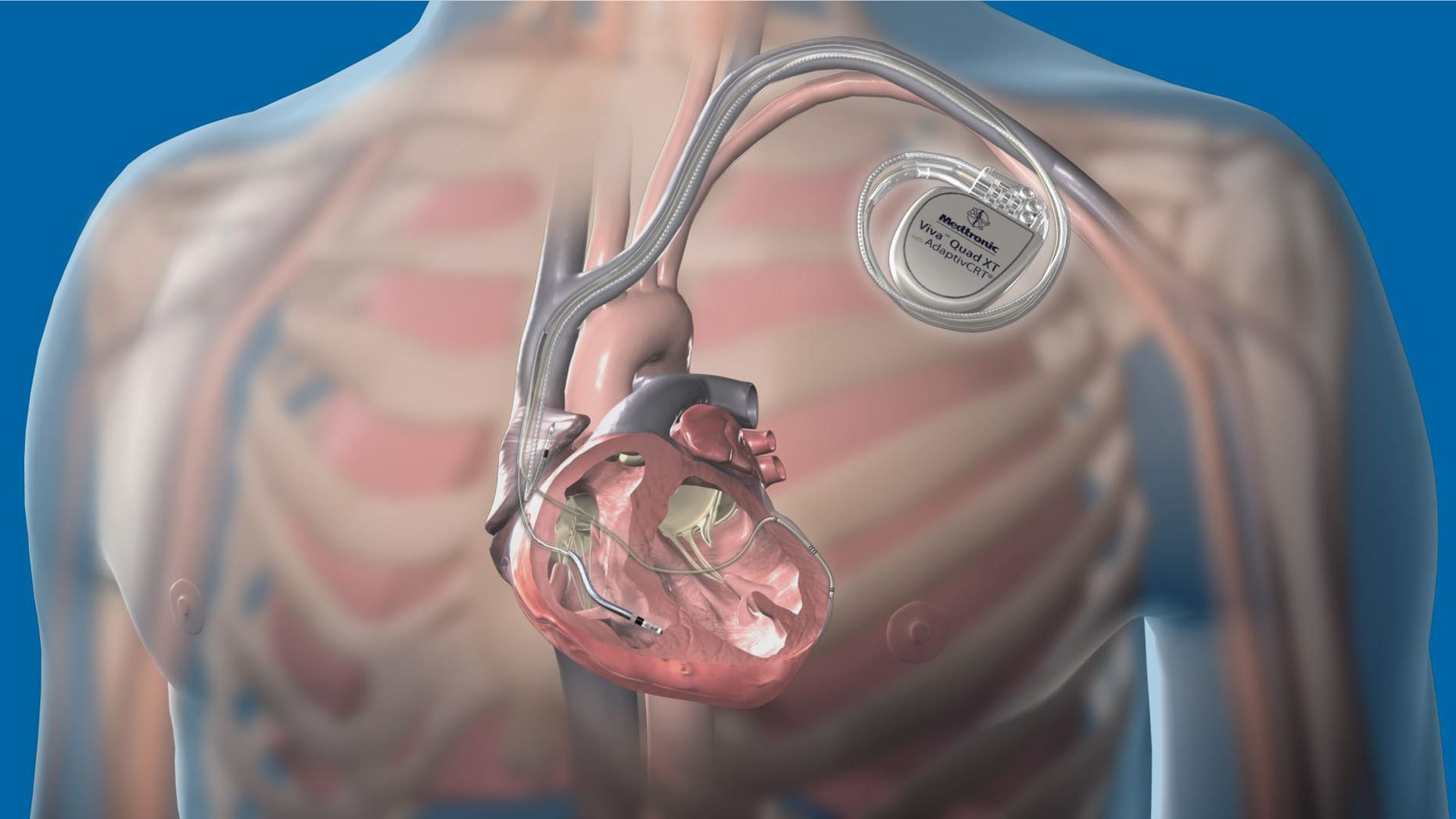 A new report in the Journal of the American College of Cardiology says there is a possibility that pacemakers and other electrical medical devices could be hacked.