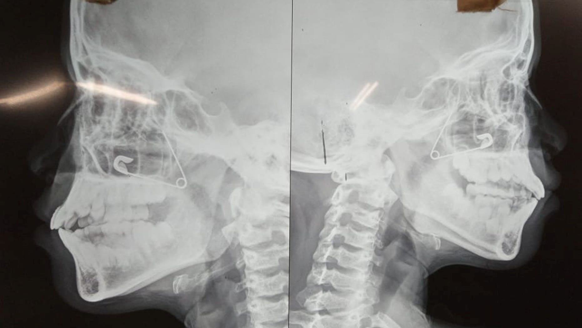 The 10-year-old girl needed surgery after getting a safety pin wedged up her nose.