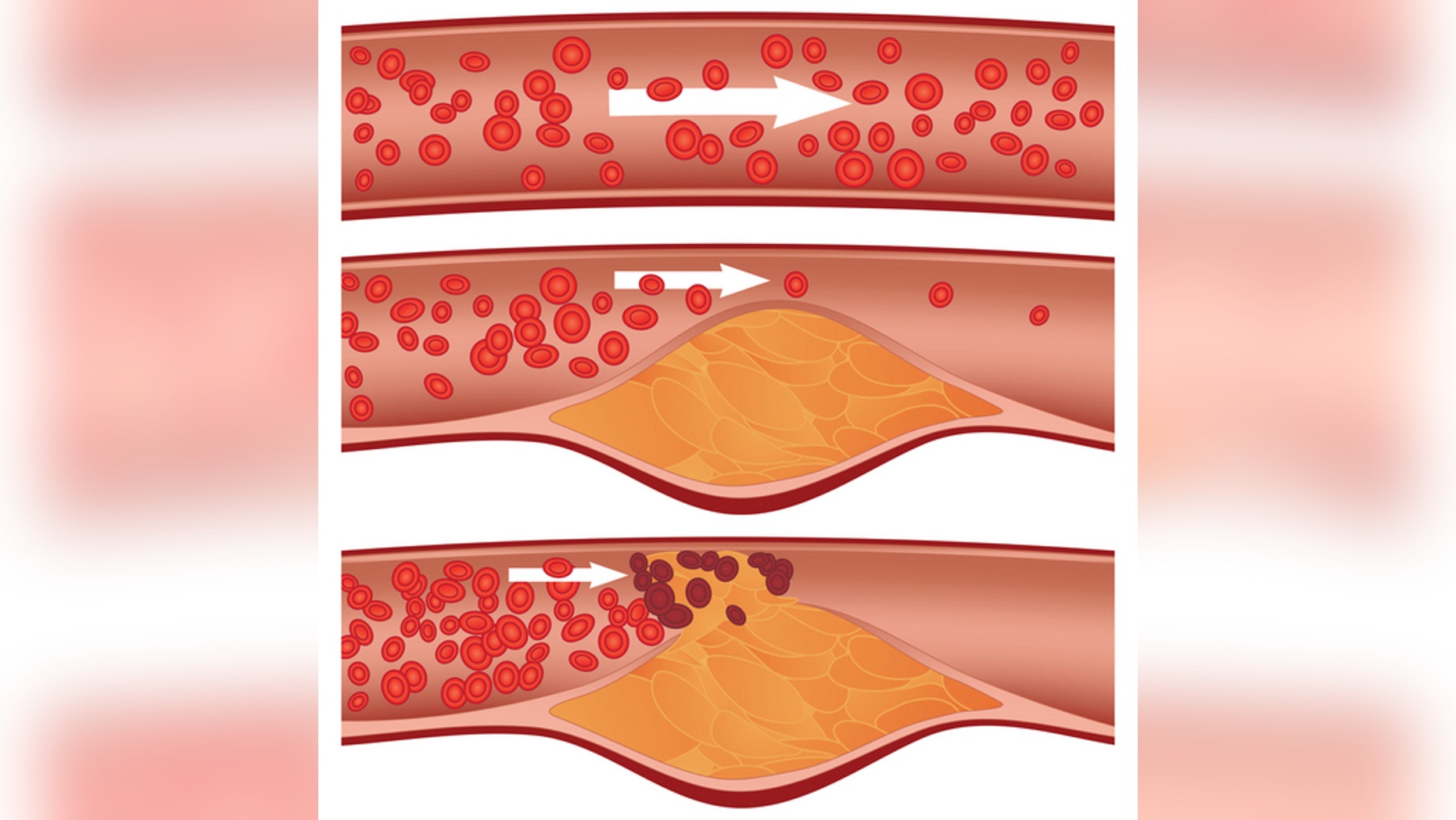 Cholesterol plaque in artery (atherosclerosis): Top artery is healthy. Middle & bottom arteries show plaque formation, rupturing, clotting & blood flow occlusion.