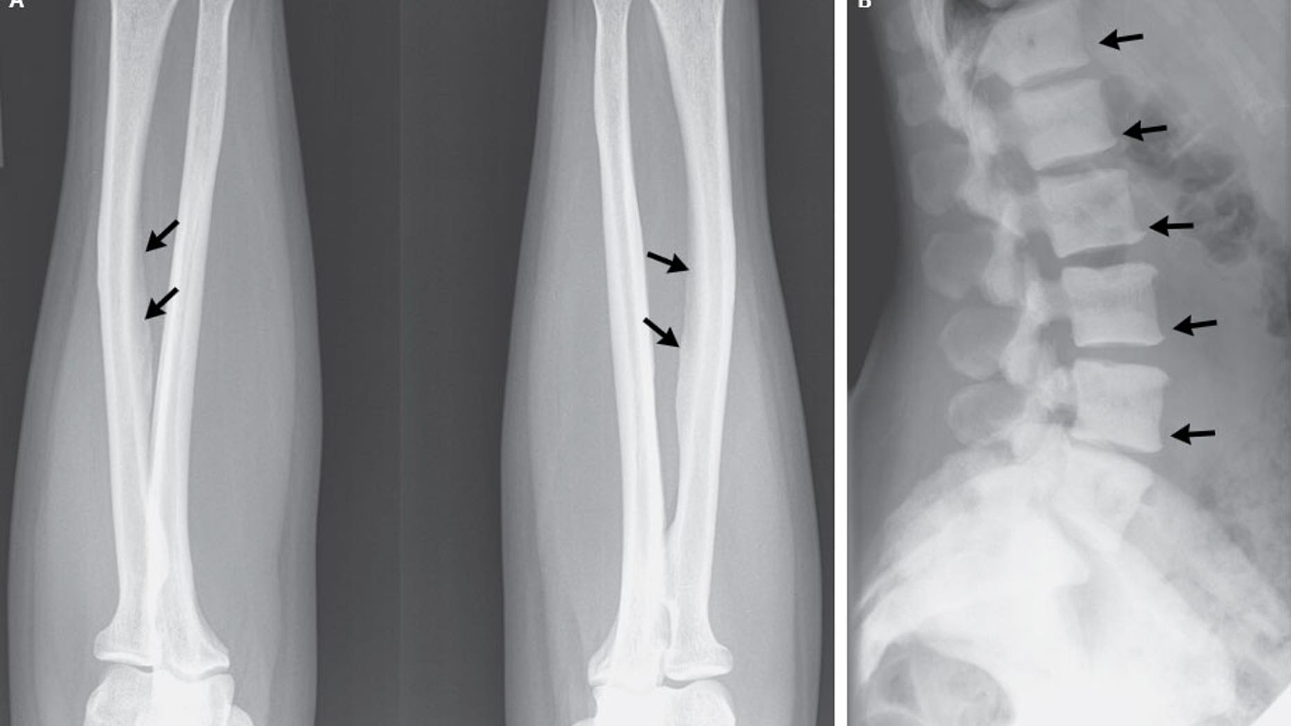 A 47-year-old U.S. woman developed a bone disease rarely seen in the U.S. after consuming an excessive amount of tea. An x-ray showed calcifications on ligaments (left) and areas of dense bone on the spinal vertebrae (right).