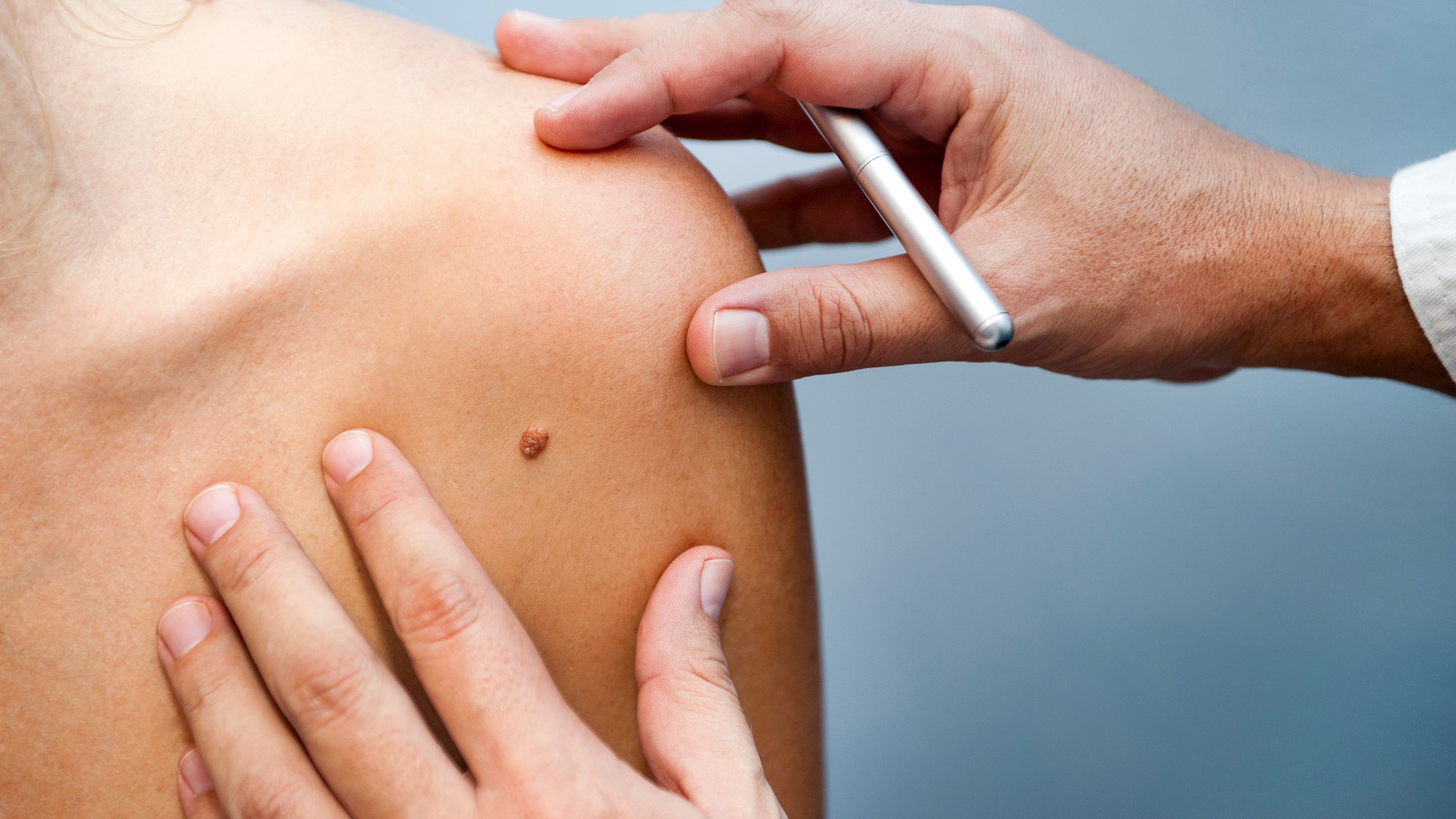 A medical consultation at the Removal of nevus.