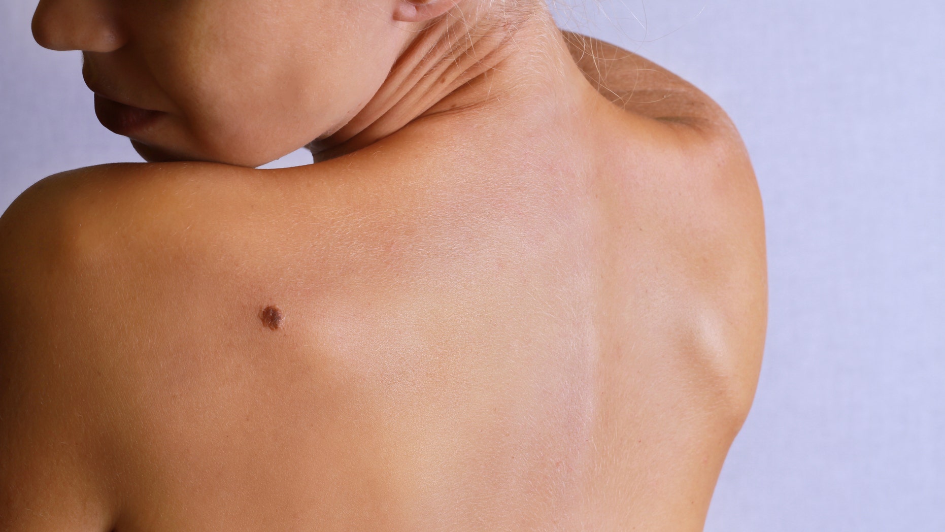 Young woman lookimg at birthmark on her back, skin. Checking benign moles