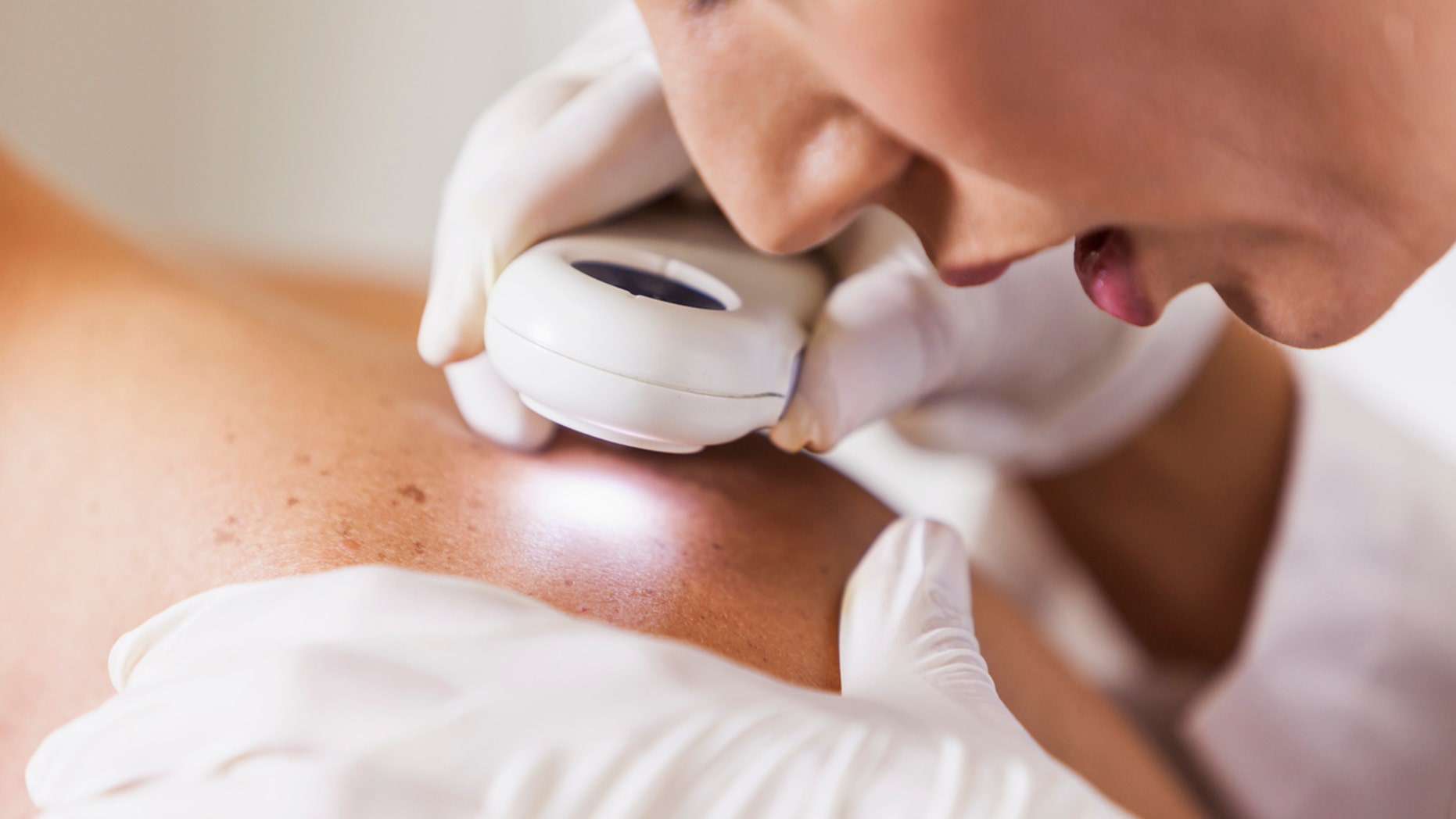 Female dermatologist (30s) examining male patient's skin with dermascope, carefully looking at a mole for signs of skin cancer.