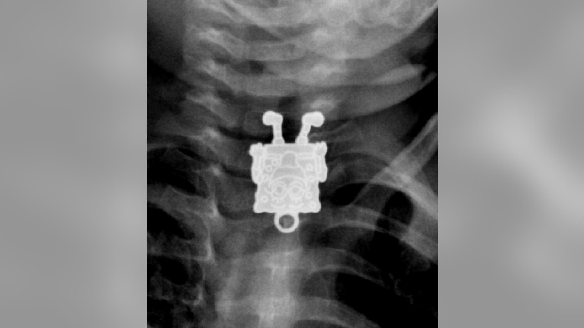 An X-ray shows a SpongeBob pendant swallowed by a kid.