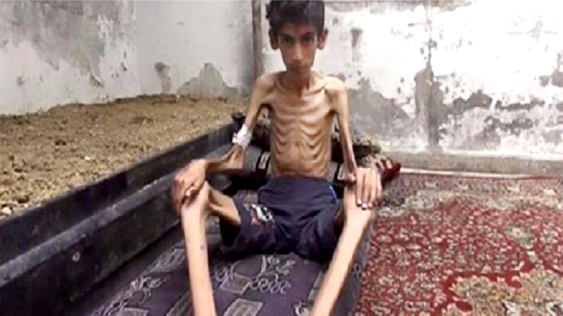 This undated photo posted on the Local Revolutionary Council in Madaya, which has been verified and is consistent with other AP reporting, shows a starving boy in Madaya, Syria. (Local Revolutionary Council in Madaya via AP)