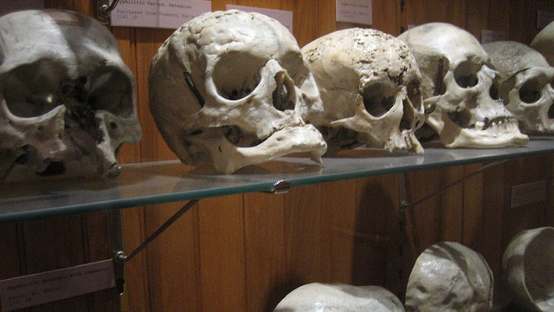 Skulls with tell-tale signs of syphilis (pictured above) may prove that the sexually transmitted disease existed in Europe centuries before Columbus discovered the New World.