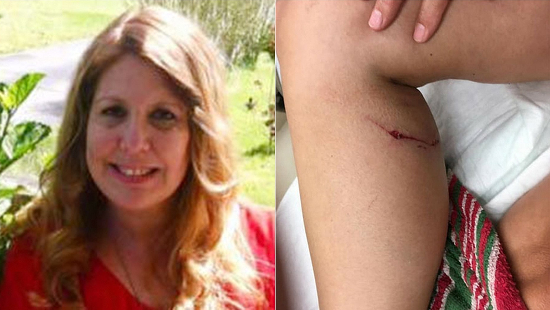 Tammy DuBois, 52, said a rabid fox attacked her leg outside her New Jersey home, forcing her to strangle the animal.