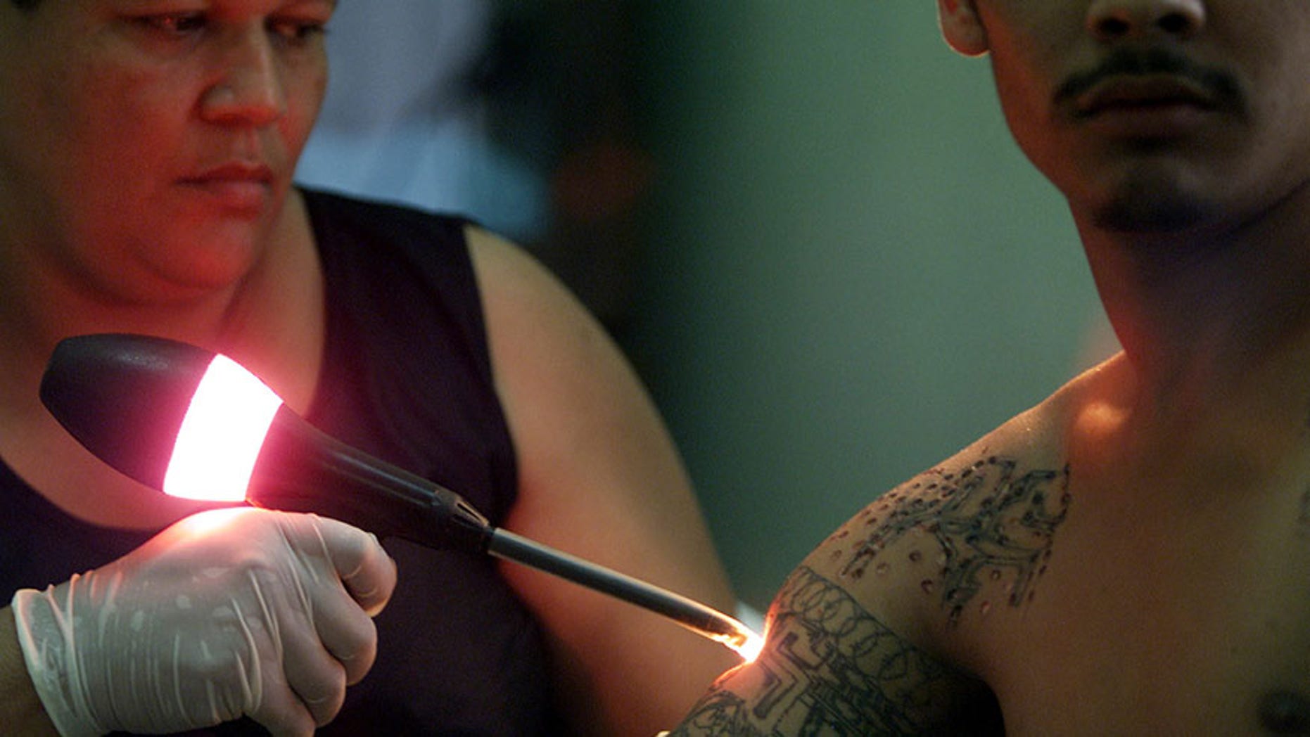 File picture of a former gang member undergoing a process for tattoo removal in San Pedro Sula, Honduras.