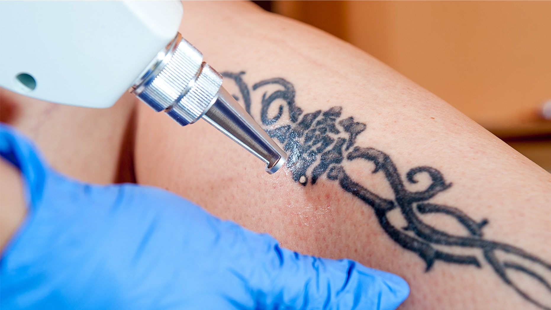 A free tattoo removal program is offering its services to young survivors of sex trafficking.