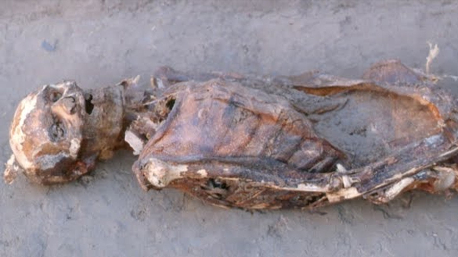One of the Nubian mummies studied by the team led by Amber Campbell Hibbs and George Armelagos at Emory University