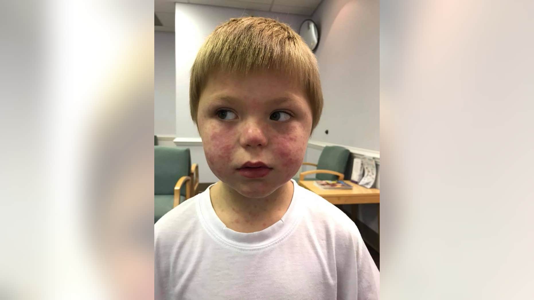 Mason McNair, 5, broke out in a rash due to the tick bite.