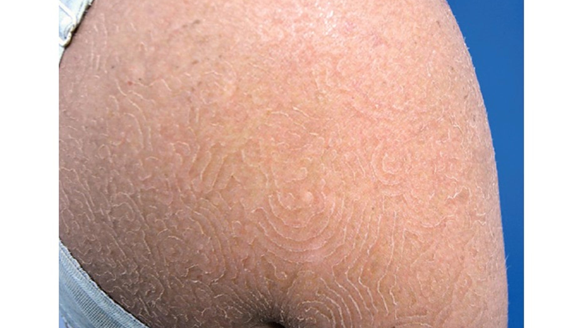 This image shows a young woman's rash, caused by the fungus Trichophyton concentricum.