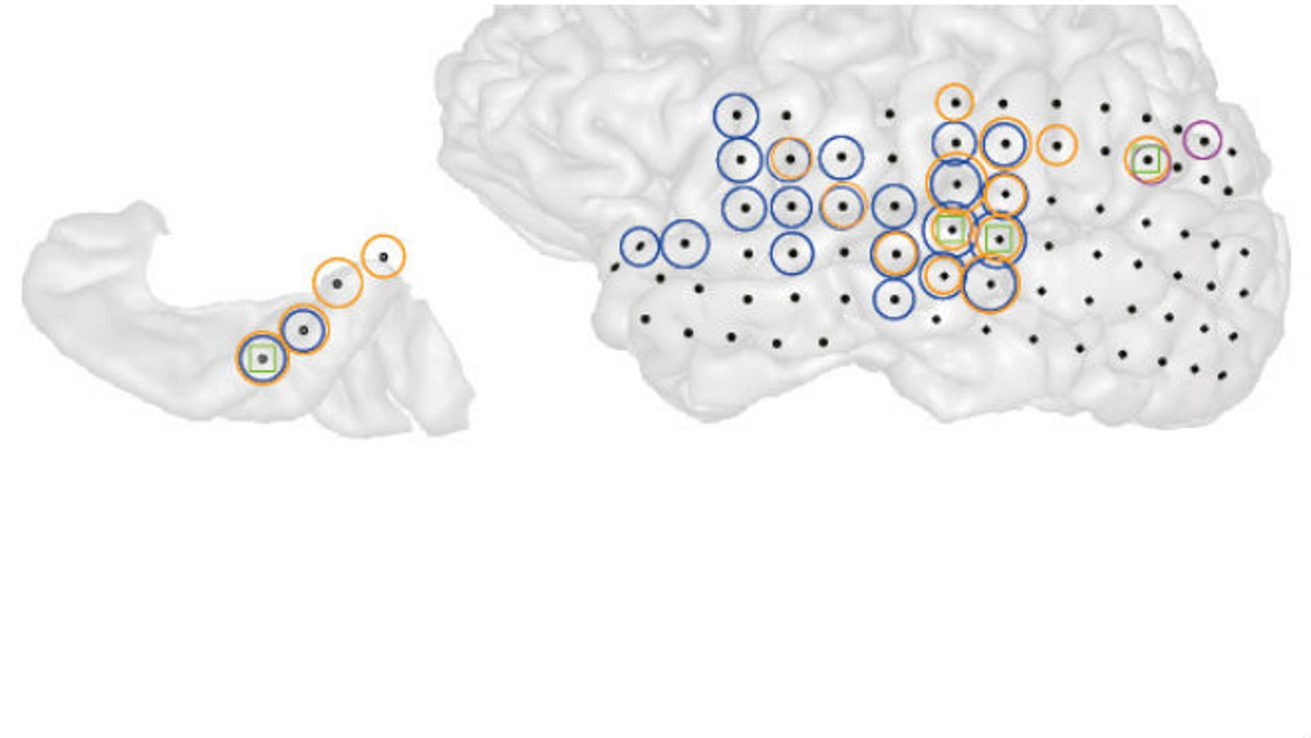 This is a 3-D image of the left brain hemisphere of a patient with tinnitus (right) and the part of that hemisphere containing primary auditory cortex (left). Black dots indicate all the sites recorded from. Colored circles indicate electrodes at which the strength of ongoing brain activity correlated with the current strength of tinnitus perceived by the patient. Different colors indicate different frequencies of brain activity (blue = low, magenta = middle, orange = high) whose strength changed alongside tinnitus. Green squares indicate sites where the interaction between these different frequencies changed alongside changes in tinnitus. (Image: Sedley, W et al.)