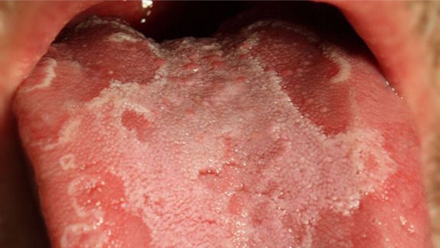 The unusual condition known as "geographic tongue" causes red and white patches that give the appearance of continents on a map.