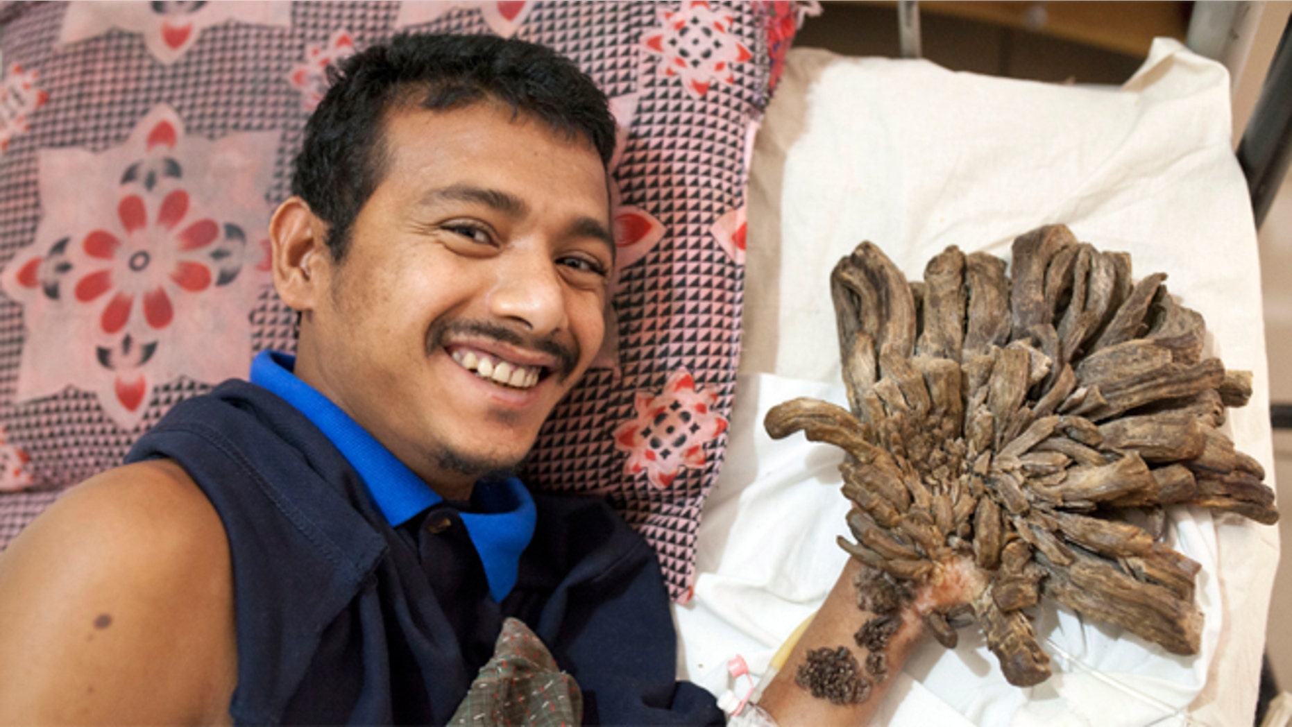 Abul Bjandar had growths on his hands and legs weighing up to 11 pounds.