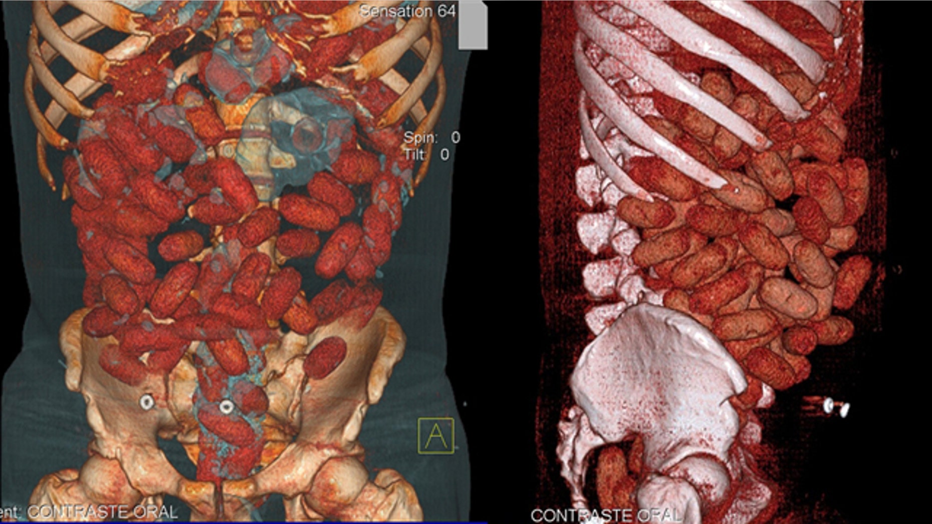 This handout medical image released by the Brazilian Federal Police shows cocaine-stuffed bags inside the gastrointestinal tract of a 20-year-old Irish national arrested by police at Congonhas airport in Sao Paulo, Brazil, on September 12.