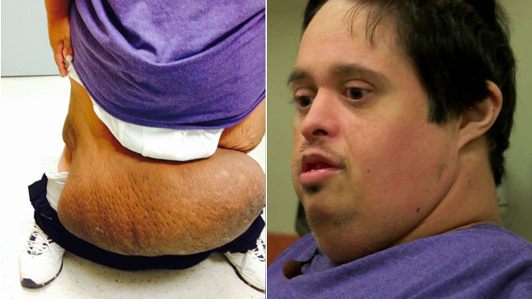 Matthew Qureshi, right, had a 60-pound tumor growing on his leg.