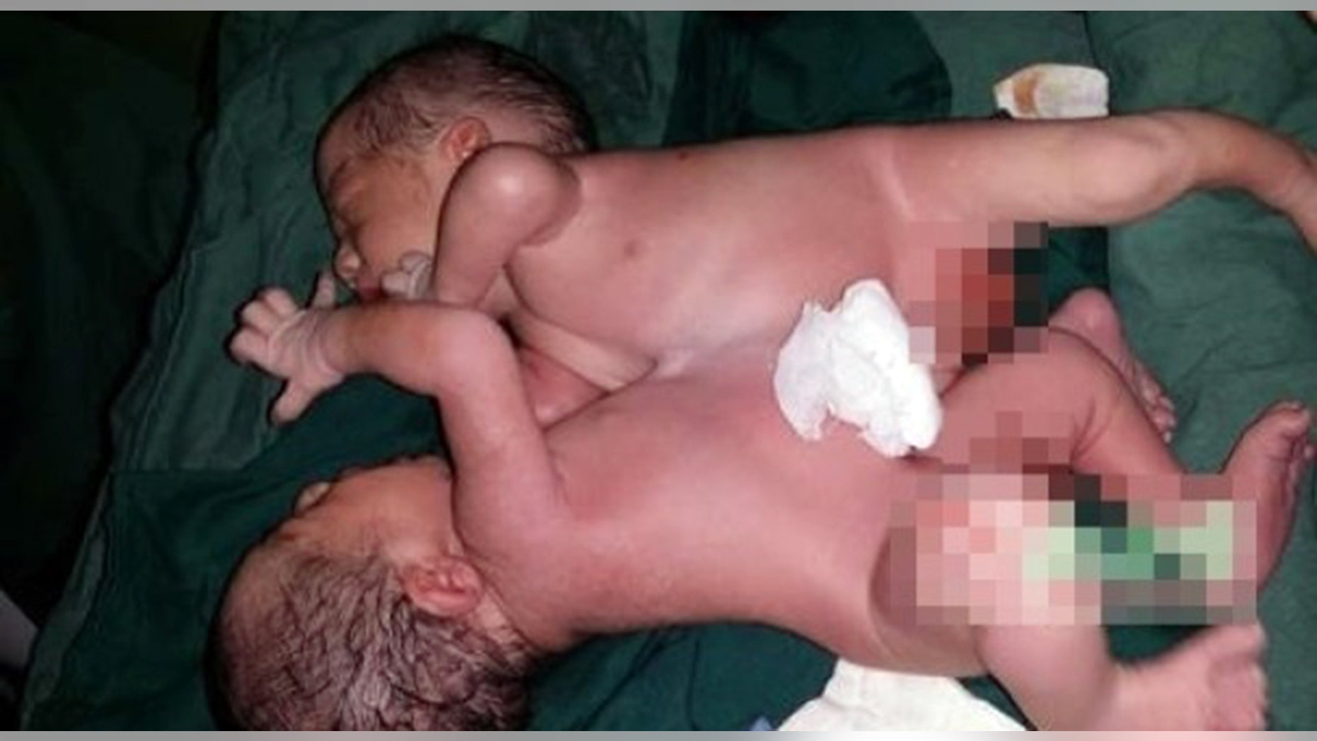 A Chinese mother gave birth to twins joined at the liver.