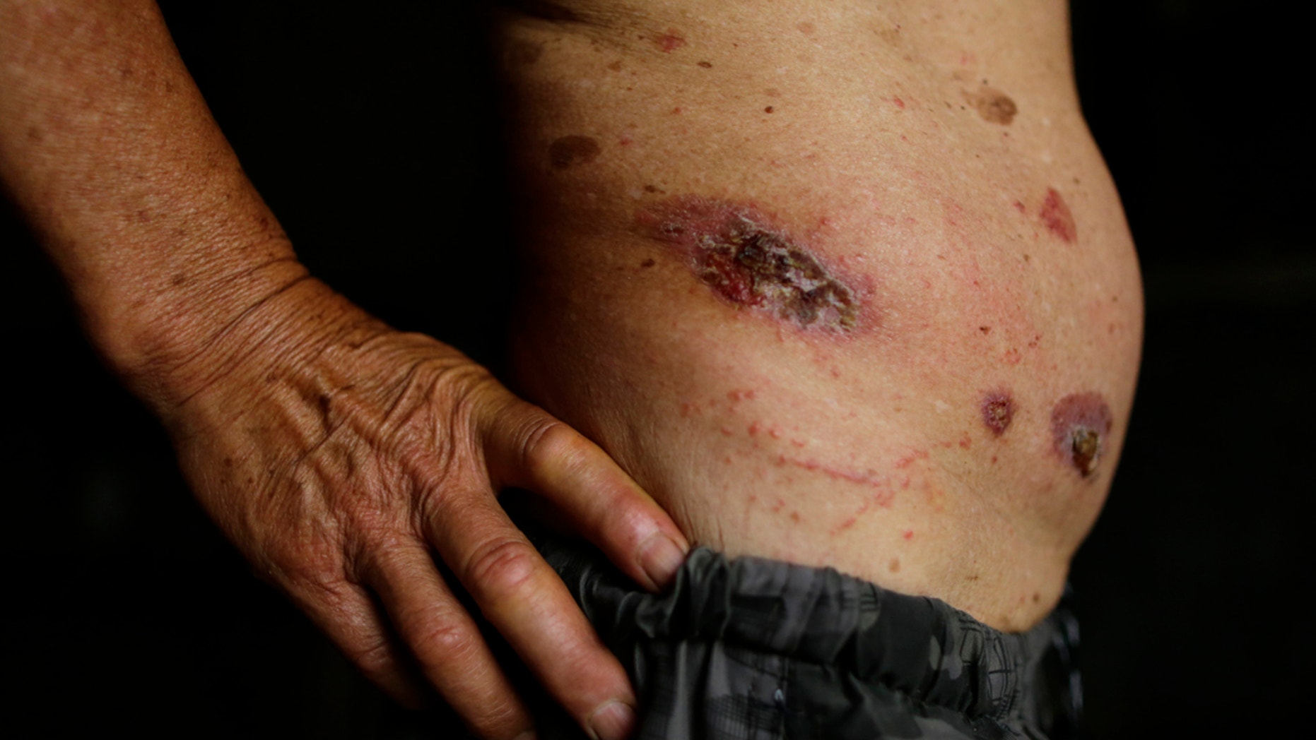 Doctors in Australia are looking for answers as they continue to investigate the Buruli ulcer "epidemic."